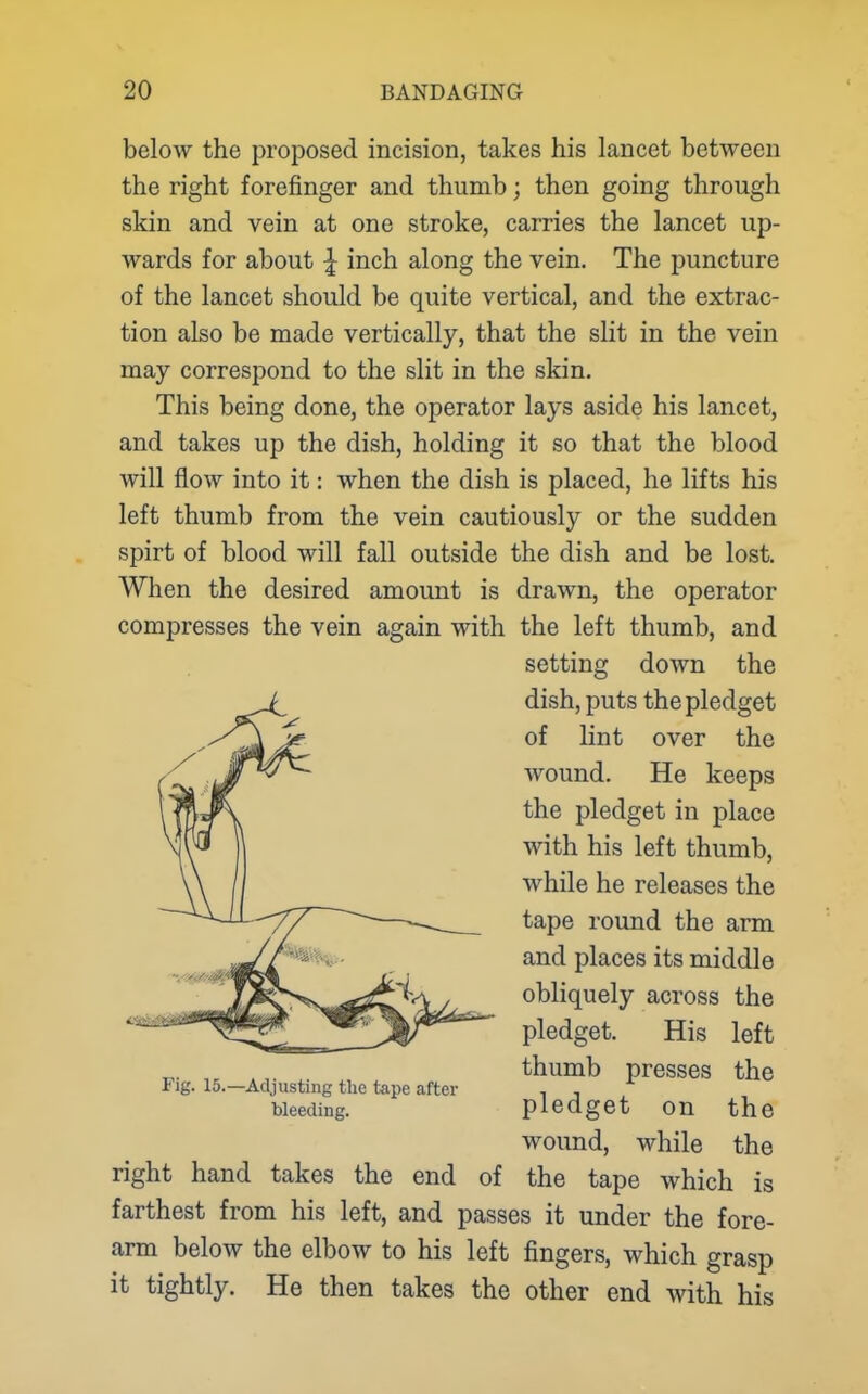 below the proposed incision, takes his lancet between the right forefinger and thumb; then going through skin and vein at one stroke, carries the lancet up- wards for about ^ inch along the vein. The puncture of the lancet should be quite vertical, and the extrac- tion also be made vertically, that the slit in the vein may correspond to the slit in the skin. This being done, the operator lays aside his lancet, and takes up the dish, holding it so that the blood will flow into it: when the dish is placed, he lifts his left thumb from the vein cautiously or the sudden spirt of blood will fall outside the dish and be lost. When the desired amount is drawn, the operator compresses the vein again with the left thumb, and wound, while the right hand takes the end of the tape which is farthest from his left, and passes it under the fore- arm below the elbow to his left fingers, which grasp it tightly. He then takes the other end with his Fig. 15.—Adjusting the tape after bleeding. setting down the dish, puts the pledget of lint over the wound. He keeps the pledget in place with his left thumb, while he releases the tape round the arm and places its middle obliquely across the pledget. His left thumb presses the pledget on the