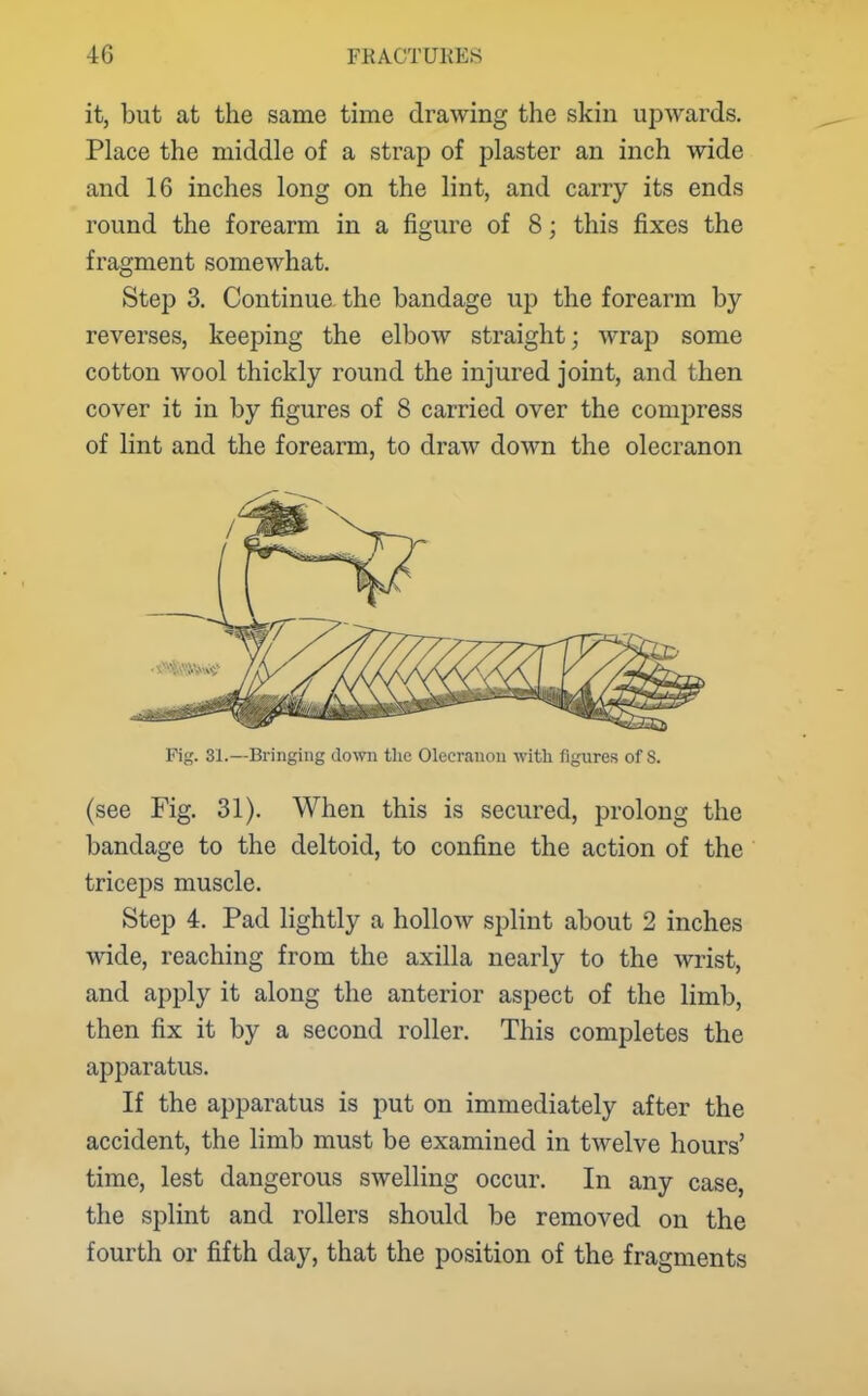 it, but at the same time drawing the skin upwards. Place the middle of a strap of plaster an inch wide and 16 inches long on the lint, and carry its ends round the forearm in a figure of 8; this fixes the fragment somewhat. Step 3. Continue the bandage up the forearm by reverses, keeping the elbow straight; wrap some cotton wool thickly round the injured joint, and then cover it in by figures of 8 carried over the compress of lint and the forearm, to draw down the olecranon Fig. 31.—Bringing down the Olecranon with figures of 8. (see Fig. 31). When this is secured, prolong the bandage to the deltoid, to confine the action of the triceps muscle. Step 4. Pad lightly a hollow splint about 2 inches wide, reaching from the axilla nearly to the wrist, and apply it along the anterior aspect of the limb, then fix it by a second roller. This completes the apparatus. If the apparatus is put on immediately after the accident, the limb must be examined in twelve hours' time, lest dangerous swelling occur. In any case, the splint and rollers should be removed on the fourth or fifth day, that the position of the fragments