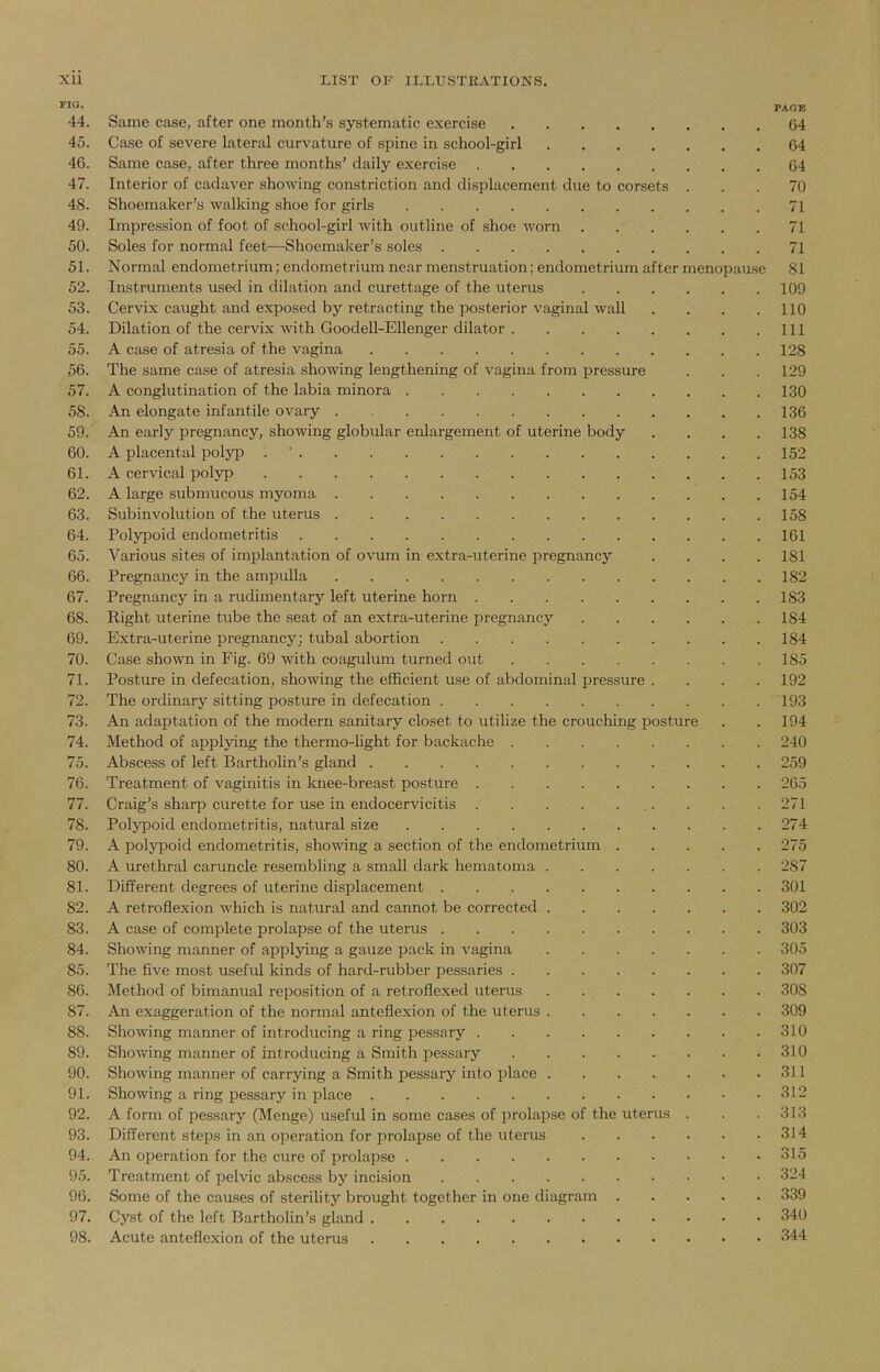 ™- PAGE 44. Same case, after one month's systematic exercise 64 45. Case of severe lateral curvature of spine in school-girl 64 46. Same case, after three months' daily exercise 64 47. Interior of cadaver showing constriction and displacement due to corsets ... 70 48. Shoemaker's walking shoe for girls 71 49. Impression of foot of school-girl with outline of shoe worn 71 50. Soles for normal feet—Shoemaker's soles 71 51. Normal endometrium; endometrium near menstruation; endometrium after menopause 81 52. Instruments used in dilation and curettage of the uterus 109 53. Cervix caught and exposed by retracting the posterior vaginal wall . . . .110 54. Dilation of the cervix with Goodell-Ellenger dilator Ill 55. A case of atresia of the vagina 128 56. The same case of atresia showing lengthening of vagina from pressure . . . 129 57. A conglutination of the labia minora 130 58. An elongate infantile ovary 136 59. An early pregnancy, showing globular enlargement of uterine body .... 138 60. A placental polyp . ' 152 61. A cervical polyp 153 62. A large submucous myoma 154 63. Subinvolution of the uterus 158 64. Polypoid endometritis 161 65. Various sites of implantation of ovum in extra-uterine pregnancy .... 181 66. Pregnancy in the ampulla 182 67. Pregnancy in a rudimentary left uterine horn 183 68. Right uterine tube the seat of an extra-uterine pregnancy 184 69. Extra-uterine pregnancy; tubal abortion 184 70. Case shown in Fig. 69 with coagulum turned out 185 71. Posture in defecation, showing the efficient use of abdominal pressure .... 192 72. The ordinary sitting posture in defecation 193 73. An adaptation of the modern sanitary closet to utilize the crouching posture . . 194 74. Method of applying the thermo-light for backache . . 240 75. Abscess of left Bartholin's gland 259 76. Treatment of vaginitis in knee-breast posture 265 77. Craig's sharp curette for use in endocervicitis 271 78. Polypoid endometritis, natural size 274 79. A polypoid endometritis, showing a section of the endometrium 275 80. A urethral caruncle resembling a small dark hematoma 287 81. DifTerent degrees of uterine displacement 301 82. A retroflexion which is natural and cannot be corrected 302 83. A case of complete prolapse of the uterus 303 84. Showing manner of applying a gauze pack in vagina 305 85. The five most useful kinds of hard-rubber pessaries 307 86. Method of bimanual reposition of a retroflexed utenis 308 87. An exaggeration of the normal anteflexion of the uterus 309 88. Showing manner of introducing a ring pessary 310 89. Showing manner of introducing a Smith pessary 310 90. Showing manner of carrying a Smith pessary into place 311 91. Showing a ring pessary in place 312 92. A form of pessary (Menge) useful in some cases of prolapse of the uterus . . .313 93. Different steps in an operation for prolapse of the uterus 314 94. An operation for the cure of prolapse 315 95. Treatment of pelvic abscess by incision 324 96. Some of the causes of sterility brought together in one diagram 339 97. Cyst of the left Bartholin's gland 340 98. Acute anteflexion of the uterus 344