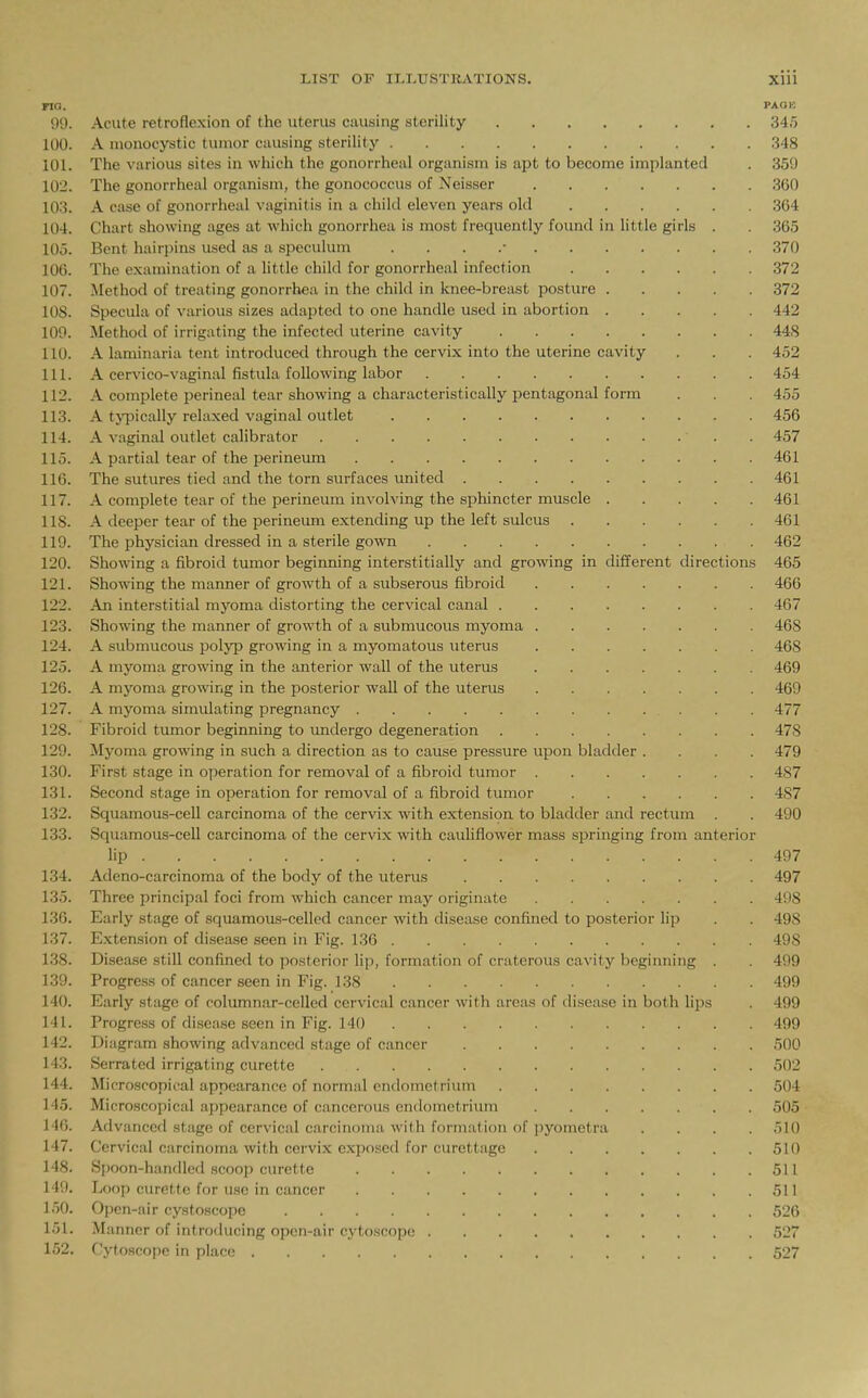 no. PAOE 99. 345 100. 101. The various sites in which the gonorrheal organism is apt to become implanted 350 102. 11 * i 1 'XT • 360 103. A case of gonorrheal vaginitis in a child eleven years old 364 104. Chart showing ages at which gonorrhea is most Irequently found in little girls . 365 105. 370 106. 372 107. Method of treating gonorrhea in the child in knee-breast posture 372 lOS. Specula of various sizes adapted to one handle used in abortion 442 109. Method of irrigating the infected uterine cavity 448 110. A laminana tent introduced through the cervix into the uterine cavity 452 111. 1 • •lfill'11 • 1 ^1 454 112. A complete perineal tear showing a characteristically pentagonal form 455 113. A typically relaxed vaginal outlet 456 114. 457 115. 461 116. ml Ijli /• J^l 461 117. A complete tear of the perineum involving the sphincter muscle 461 lis. A deeper tear of the perineum extending up the left sulcus 461 119. The physician dressed in a sterile gown 462 120. Showing a fibroid tumor beginning interstitially and growing m dirierent directions 465 121. 466 122. An interstitial myoma distorting the cervical canal 467 123. 468 124. 468 125. I ■ • 1 1 1 _ • 11 _p 1 1 _ 1 469 126. A myoma growing in the posterior wall of the uterus 469 127. 477 128. 478 129. Myoma growing in such a direction as to cause pressure upon bladder .... 479 130. 487 131. Second stage in operation for removal of a fibroid tumor 487 132. CI 11 • fit ' 'il I •(1111 1 1 oquamous-celi carcinoma of the cervix with extension to bladder and rectum 490 133. ft 11 • Til ''it 1' n ' ' f .* bquamous-cell carcinoma oi the cervix with cauliflower mass springing trom anterior I'P 497 134. AT • c j_l 1 1 f 1 ^ 1 497 135. rvi_ ' ' y p ' p 1*1 • • I 498 136. iiiarly stage of squamous-celled cancer with disease confined to posterior hp 498 137. 498 138. Disease still conhned to posterior hp, formation of cratcrous cavity beginning . 499 139. Progress of cancer seen in Fig. 138 499 140. barly stage of columnar-celled cervical cancer with areas of disease in both hps 499 141. rrogress of disease seen in Fig. 140 499 142. Diagram showing advanced stage of cancer 500 143. Serrated irrigating curette 502 144. Microscopical appearance of normal endometrium 504 145. 505 146. Advanced stage of cervical carcinoma with formation of pyometra .... 510 147. Cervical carcinoma with cervix exijoscd for curettage 510 148. 511 140. Loop curette for use in cancer 511 150. Open-air cystoscope 526 151. 527 152. Cytoscope in place 527