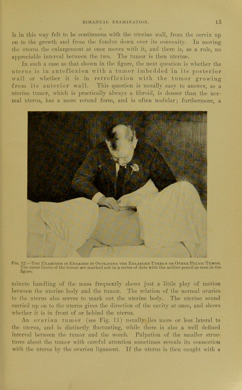 is in this way felt to be continuous with the uterine wall, from tlie cervix up on to tlio growth and from the fundus down over its convexity. In moving the uterus the enlargement at once moves with it, and thei'e is, as a rule, no appreciable interval between the two. The tuuior is then uterine. In such a case as that shown in the figure, the next question is whether the uterus is in anteflexion with a tumor imbedded in its posterior wall or whether it is in retroflexion with the tumor growing froui its anterior wall. This question is usually easy to answer, as a uterine tumor, which is practically always a fibroid, is denser than the nor- mal uterus, has a more rotund form, and is often nodular; furthermore, a Fig. 12.—The Examiner is IOnoaged in Outlining the Enlarged Uterus or Other Pelvic Tumor. The outer limits of the tiiiiior are marked out in a series of dots with the aniline pencil as seen in the figure. minute handling of the mass frequently shows just a little play of motion between tlie uterine body and the tumor. 'I'he relation of the normal ovaries to tlie uterus also serves to mark out the uterine body. Tlie uterine sound carried up on to the uterus gives the direction of the cavity at once, and shows whether it is in front of or behind the uterus. An ovarian tumor (see Fig. 11) usually: lies more or less lateral to the uterus, and is distinctly fluctuating, while there is also a well defined interval between the tumor and the womb. Palpation of the smaller struc- tures about the tumor with careful attention sometimes reveals its connection with the uterus by the ovarian ligament. If the uterus is then caught with a