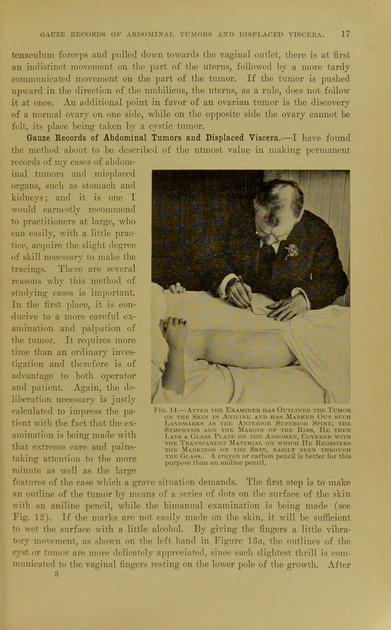 tenaculum forceps and pulled down towards the vaginal outlet, there is at first an indistinct movement on the part of the iitorns, followed by a more tardy communicated movement on the part of the tumor. If the tumor is pushed upward in the direction of the umbilicus, the uterus, as a rule, does not follow it at once. An additional point in favor of an ovarian tumor is the discovery of a normal ovary on one side, while on the opposite side the ovary cannot be fcdt, its place being taken by a cystic tumor. Gauze Records of Abdominal Tumors and Displaced Viscera.-—I have found the method about to be described of the utmost value in making permanent records of my cases of abdom- inal tumors and misplaced organs, such as stomach and kidnevs: and it is one I would earnestly recommend to practitioners at large, wlio can easily, with a little prac- tice, acquire the slight degree of skill necessary to make the tracings. There are several reasons why this metbod of studying cases is important. In the first place, it is con- ducive to a more careful ex- amination and palpation of the tumor. It requires more time than an ordinary inves- tigation and therefore is of advantage to both operator and patient. Again, the de- liberation necessary is justly \ calculated to impress the pa- tient with the fact that the ex- amination is being made with that extreme care and pains- taking attention to the more minute as well as the large features of the case which a grave situation demands. The first step is to make an outline of the tumor by means of a series of dots on tlie surface of the skin with an aniline pencil, while the bimanual examination is being made (see Fig, 12). If the marks are not easily made on the skin, it will be sufiicient to wet the surface with a little alcohol. By giving the fingers a little vibra- tory movement, as shown on the left hand in Figure ISa, the outlines of the cyst or tumor are more delicately appreciated, since each slightest thrill is com- municated to the vaginal fingers resting on the lower pole of the growth. After 8 Fig. 14.—After the Examiner has Outlined the Tumor ON THE Skin in Aniline and has Marked Out such Landmarks as the Anterior Superior Spine, the Symphysis and the Margin of the Rins, He then Lays a Glass Plate on the Abdomen, Covered -with THE Transparent Material on which He Registers THE Markings on the Skin, easily seen through the Glass. A crayon or carbon pencil is better for this purpo.so than an auiUne jDencil.