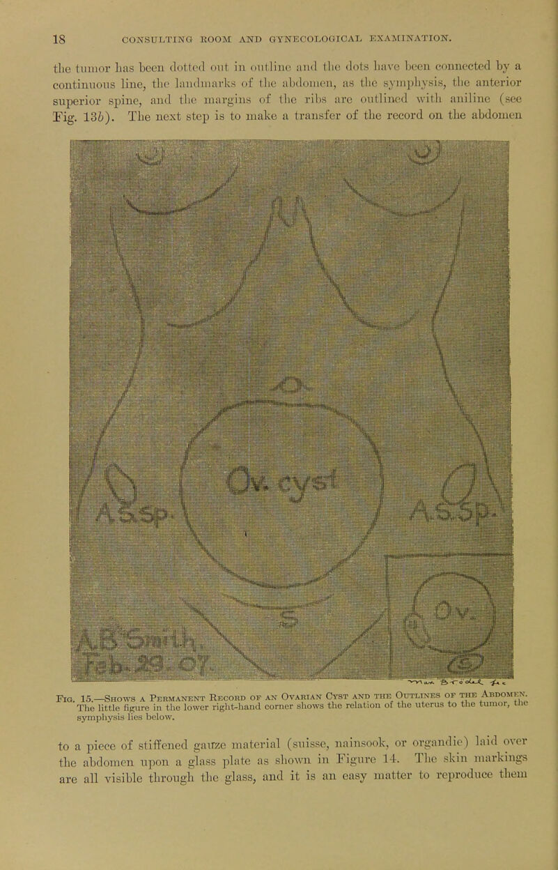 the tumor has been dotted out in outline aud tlie dots have been connected by a contimions line, the landmarks of the abdomen, as the symphysis, the anterior superior spine, and the margins of the ribs are outlined with aniline (see Tig. 136). The next step is to make a transfer of the record on the abdomen FiQ. 15.—Shows a Permanent Record of an Ovarian Cyst and the Outlines of the Abdom>:x. The little figure in tlie lower right-hand corner shows the relation of the uterus to the tumor, ine symphysis lies below. to a piece of stiffened gaiTze material (snisse, nainsook, or organdie) laid over the abdomen npon a glass plate as shown in Figure 14. The skin markings are all visible throngh the glass, and it is an easy matter to reproduce them