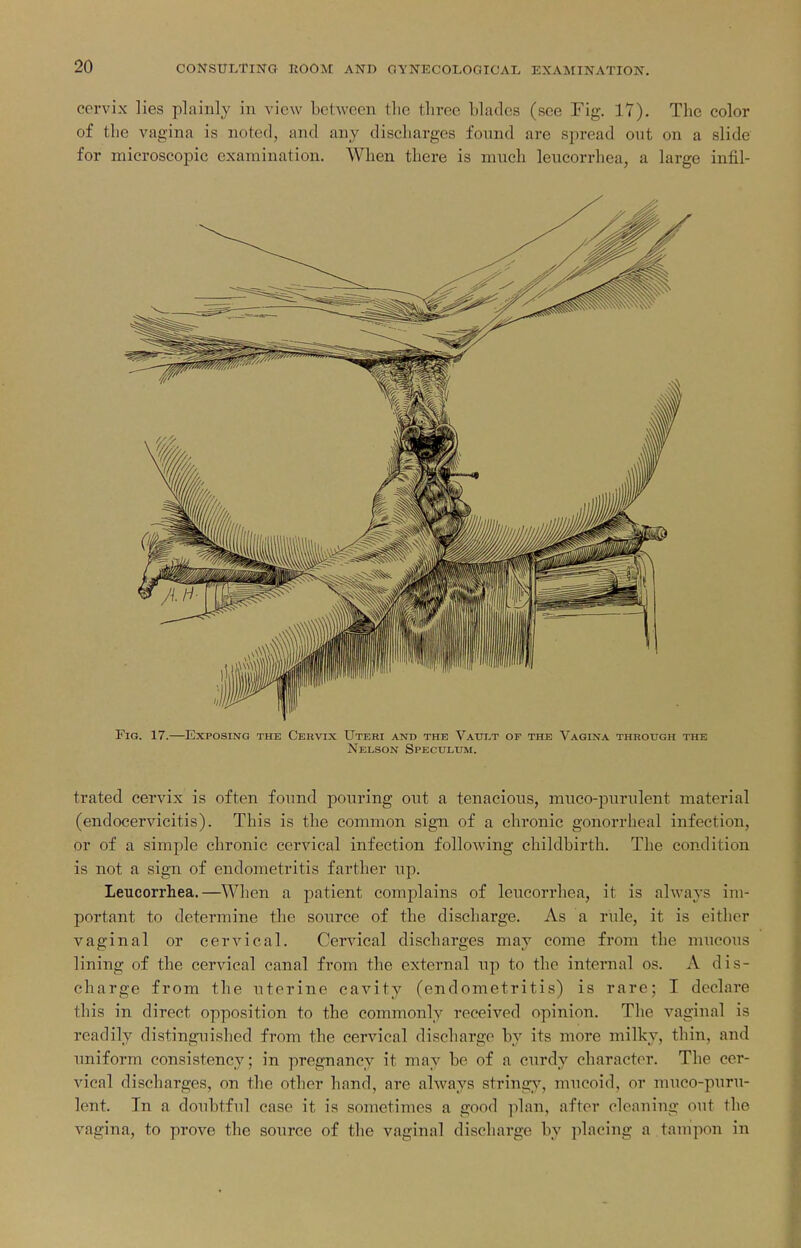 cervix lies plainly in view between tlie three blades (see Fig. 17). The color of the vagina is noted, and any discharges found are spread out on a slide for microscopic examination. When there is much leucorrhea, a large infil- FiG. 17.—Exposing the Cervix Uteri and the Vaui>t op the Vagina through the Nelson Speculum. trated cervix is often found pouring out a tenacious, muco-purulent material (endocervicitis). This is the common sign of a chronic gonorrheal infection, or of a simple chronic cervical infection following childbirth. The condition is not a sign of endometritis farther up. Leucorrhea.—When a patient complains of leucorrhea, it is always im- portant to determine the source of the discharge. As a rule, it is either vaginal or cervical. Cervical discharges may come from the mucous lining of the cervical canal from the external np to the internal os. A dis- charge from the uterine cavity (endometritis) is rare; I declare this in direct opposition to the commonly received opinion. The vaginal is readily distinguished from the cervical discharge by its more milky, thin, and nniform consistency; in pregnancy it may be of a curdy character. The cer- vical discharges, on the other hand, are always strings^ mucoid, or muco-puru- lent. In a doubtful case it is sometimes a good plan, after cleaning out the vagina, to prove the source of the vaginal discharge by placing a tampon in