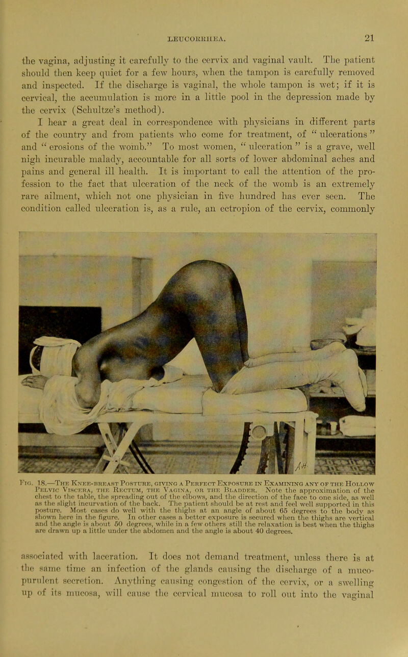 the vagina, adjusting it carefully to the cervix and vaginal vault. The patient should then keep quiet for a few hours, -when the tampon is carefully removed and inspected. If the discharge is vaginal, the whole tampon is wet; if it is cervical, the accimmlation is more in a little pool in the depression made by the cervix (Schnltze's method). I hear a great deal in correspondence with physicians in different parts of the coimtry and from patients who come for treatment, of ulcerations and erosions of the woinb. To most women, ulceration is a grave, well nie:h incurable maladv, accountable for all sorts of lower abdominal aches and pains and general ill health. It is important to call the attention of the pro- fession to the fact that ulceration of the neck of the womb is an extremely rare ailment, which not one physician in five hundred has ever seen. The condition called ulceration is, as a rule, an ectropion of the cervix, commonly FlO. 18. 1 Jlls l\NEE-nRKAST PoSTURK, OrVING A PERFECT lOxPOSURE IN l lXAMINING ANY OF 1111; lloi.I.OW Pelvic Viscera, the Rectum, the Vacjina, or the liLAnoEn. Note the approximation of the chest to the table, the spreading out of the elbows, and the direction of the face to one side, as well as the slight incurvation of the nack. Tlie patient should be at rest and feel well supported in this posture. Most cases do well with the thighs at an angle of about 65 ilegrees to the body as shown here in the figure. In other cases a octtcr exjjosure is secured when the thighs are vertical and the angle is about 60 degrees, wliile in a few others still tlic relaxation is best wlien the thighs are drawn up a little under the abdomen and the angle is about 40 degrees. associated with laceration. It does not demand treatment, unless there is at the same time an infection of the glands causing the discharge of a muco- purulent secretion. Anything causing congestion of the cervix, or a swelling up of its mucosa, will cause the cervical mucosa to roll out into the vaginal