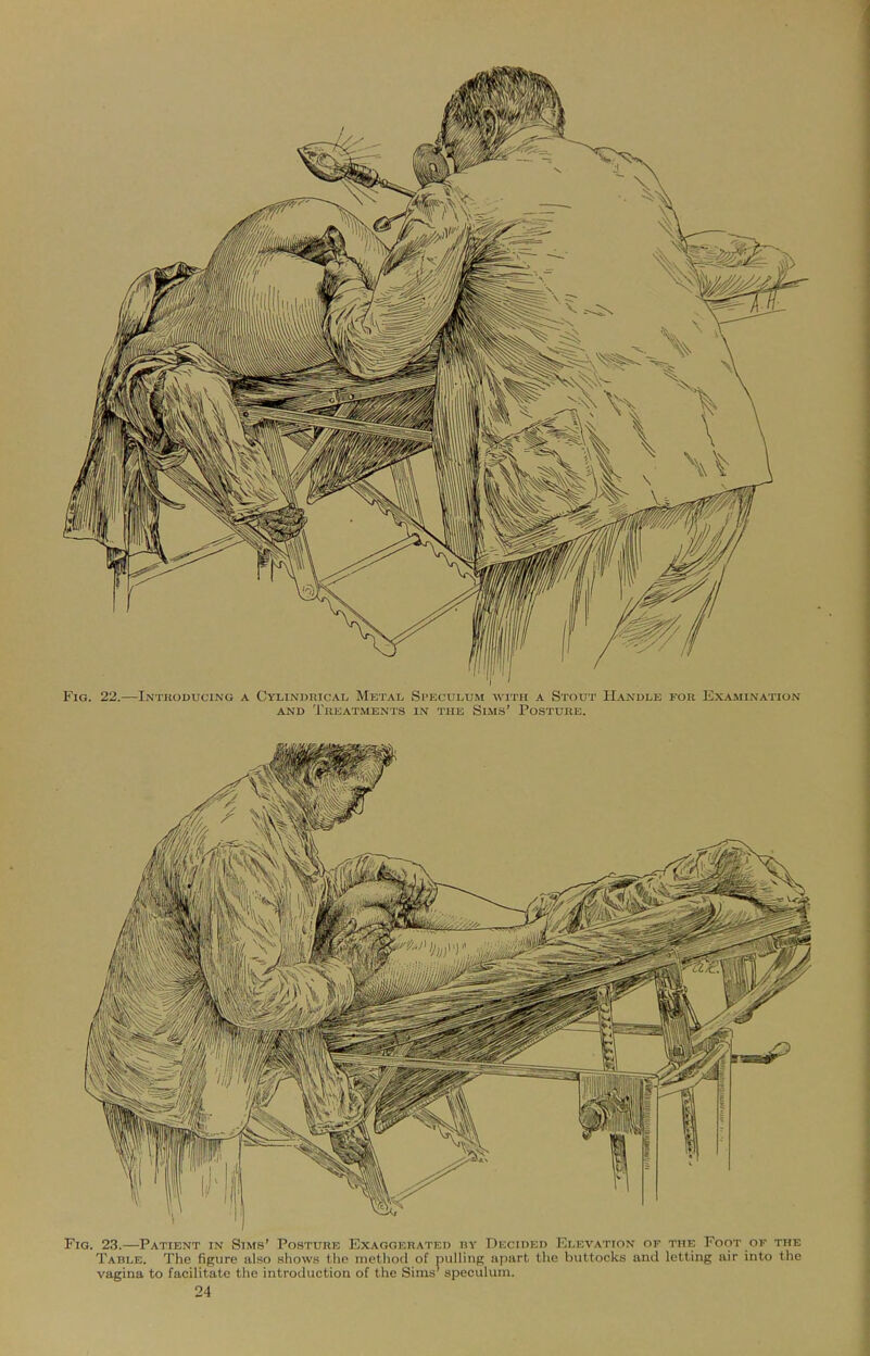 Fig. 22.—Intuoducing a CvLiNDnicAL Metal Speculum with a Stout Handle for Exa.mination AND TeEATMENTS IN THE SlMS' PoSTUnB.