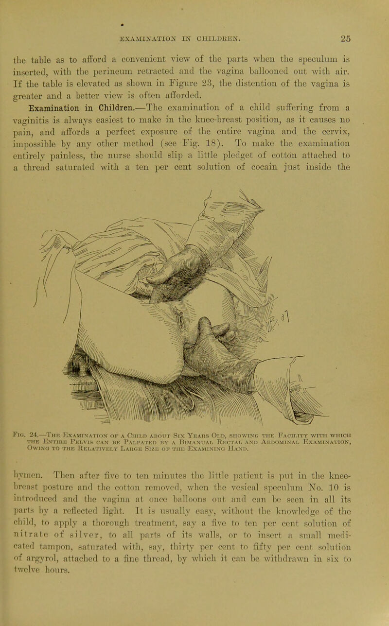 the table as to afford a convenient view of the parts when the speculum is inserted, with the perineum retracted and the vagina ballooned out with air. If the table is elevated as shown in Figure 23, the distention of the vagina is greater and a better view is often afforded. Examination in Children.—The examination of a child suffering from a vaginitis is always easiest to make in the knee-breast position, as it causes no pain, and affords a perfect exposure of the entire vagina and the cervix, impossible by any other method (see Fig. 18). To make the examination entirely painless, the nurse should slip a little pledget of cotton attached to a thread saturated with a ten per cent solution of cocain just inside the Fio. 24.—Thk Kxaminatidn- of a Cirti-n aboxit Six Years Old, siioaving the Facility with which THE EnTIRK PeLVI.S CAN DE PaM'ATKP liY A JJliMANUAL ReCTAL AN'l) AllOOMINAl, liXAMINATlON, OwiNQ TO THE Relatively Laiige Size of the Examining Hand. hymen. Then after five to ten minutes the little patient is put in the knee- hreast posture and the cotton removed, Avhen tlie vesical speculum No. 10 is introduced and the vagina at once balloons out and can be seen in all its parts by a reflected liglit. It is usually easy, without the knowledge of the child, to apply a thorough treatment, say a five to ten ])(>r cent solution of nitrate of .silver, to all parts of its Avails, or to insert a small medi- cated tampon, saturated with, say, thirty per cent to fifty per cent solution of argyrol, attached to a fine thread, by which it can be witlidrawn in six to twelve hours.