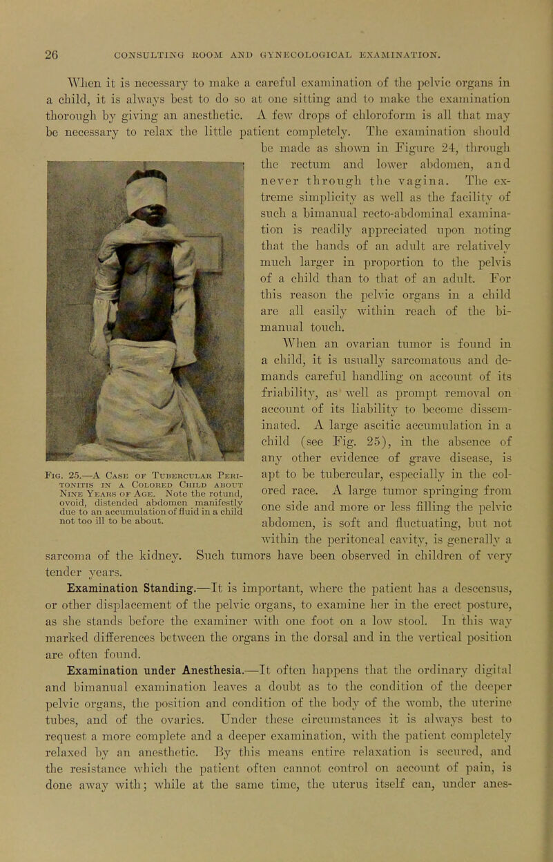 WJien it is necessary to make a careful examination of the pelvic organs in a child, it is always best to do so at one sitting and to make the examination thorough by giving an anesthetic. A few drops of chloroform is all that may be necessary to relax the little patient completely. The examination should be made as shown in Pigure 24, through the rectum and lower abdomen, and never through the vagina. The ex- treme simplicity as well as the facility of such a bimanual recto-abdominal examina- tion is readily appreciated upon noting that the hands of an adult are relatively much larger in proportion to the pelvis of a child than to that of an adult. For this reason the jiclvic organs in a child are all easily within reach of the bi- manual touch. When an ovarian tumor is found in a child, it is usually sarcomatous and de- mands careful handling on account of its friability, as well as prompt removal on account of its liability to become dissem- inated. A large ascitic accmnulation in a child (see Fig. 25), in the absence of any other evidence of grave disease, is apt to be tubercular, especially in the col- ored race. A large tumor springing from one side and more or less filling the pelvic abdomen, is soft and fluctuating, but not Avithin the peritoneal cavity, is generally a sarcoma of the kidney. Such tumors have been observed in children of very tender years. Examination Standing.—It is important, where the patient has a descensus, or other displacement of the pelvic organs, to examine her in the erect posture, as she stands before the examiner with one foot on a low stool. In this wa}-^ marked differences between the organs in the dorsal and in the vertical position are often found. Examination under Anesthesia.—It often hai^pcns that tlie ordinary digital and bimanual exauiination leaves a doubt as to the condition of the deeijer pelvic organs, the position and condition of the body of the womb, the uterine tubes, and of the ovaries. Under these circumstances it is always best to request a more complete and a deeper examination, Avith the patient completely relaxed by an anesthetic. By this means entire relaxation is secured, and the resistance which the patient often cannot control on account of pain, is done away with; while at the same time, the uterus itself can, under anes- FiG. 25.—A Case of Tttbehcular Peri- ToxiTis IN A Colored Child about Nine Years of Age. Note the rotund, ovoid, distended abdomen manifestly- due to an accumulation of fluid in a child not too ill to be about.