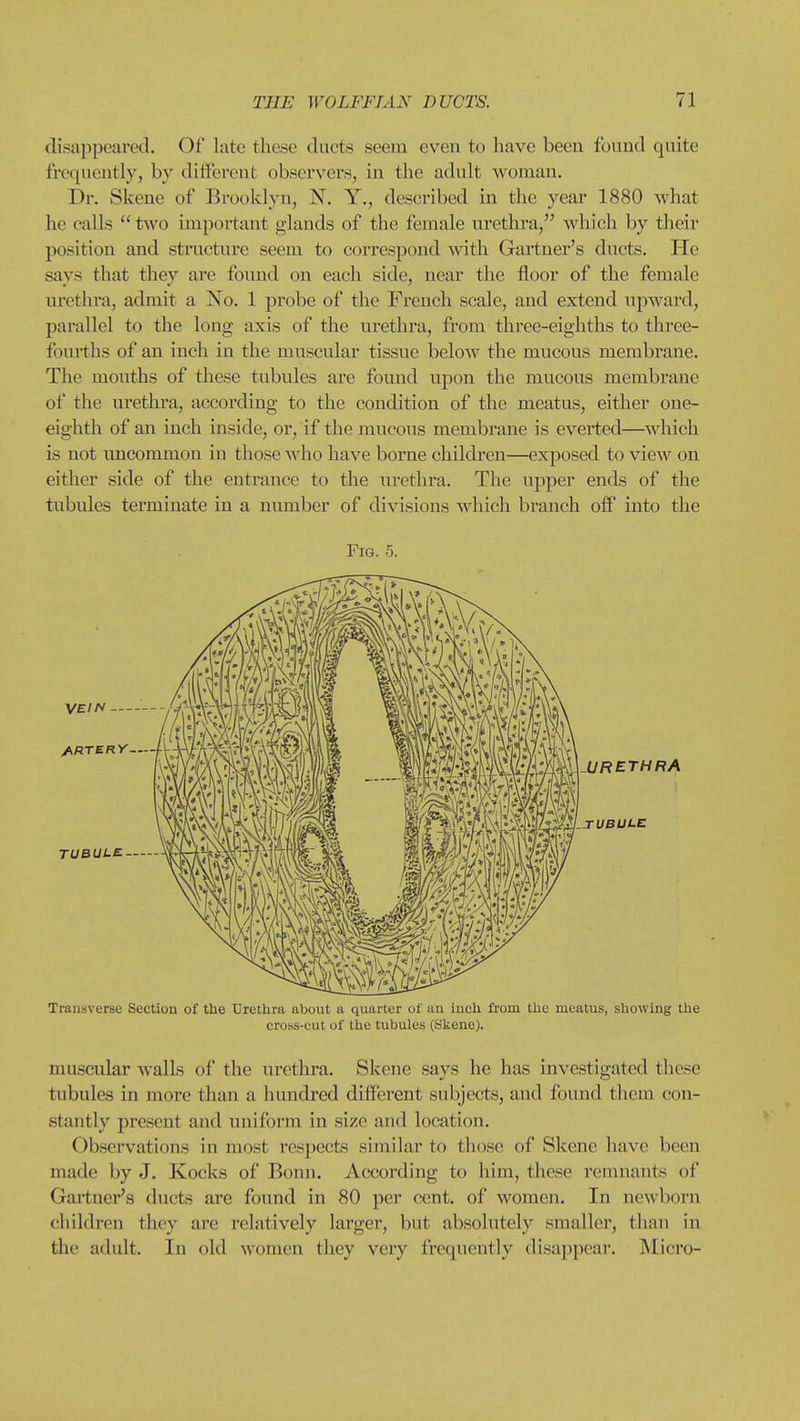 disappeared. Of late these ducts seem even to have been found quite frequently, by different observers, in the adult woman. Dr. Skene of Brooklyn, N. Y., described in the year 1880 what he calls  two important glands of tlie female urethra, which by their position and structure seem to correspond with Gartner's ducts. He says that they are found on each side, near the floor of the female urethra, admit a No. 1 probe of the French scale, and extend upward, parallel to the long axis of the urethra, from three-eighths to three- fourths of an inch in the muscular tissue below the mucous membrane. The mouths of these tubules are found upon the mucous membrane of the urethra, according to the condition of the meatus, either one- eighth of an inch inside, or, if the mucous membrane is everted—which is not uncommon in those who have borne children—exposed to view on either side of the entrance to the urethra. The upper ends of the tubules terminate in a number of divisions which branch off into the muscular walls of the urethra. Skene says he has investigated these tubules in more than a hundred dif!ei'ent subjects, and found them con- stantly present and uniform in size and location. Observations in most respects similar to those of Skene have been made by J. Kocks of Bonn. According to him, these remnants of Gartner's ducts are found in 80 per cent, of women. In newborn children they are relatively larger, but absolutely smaller, than in the adult. In old women they very frequently disappear. INIicro-