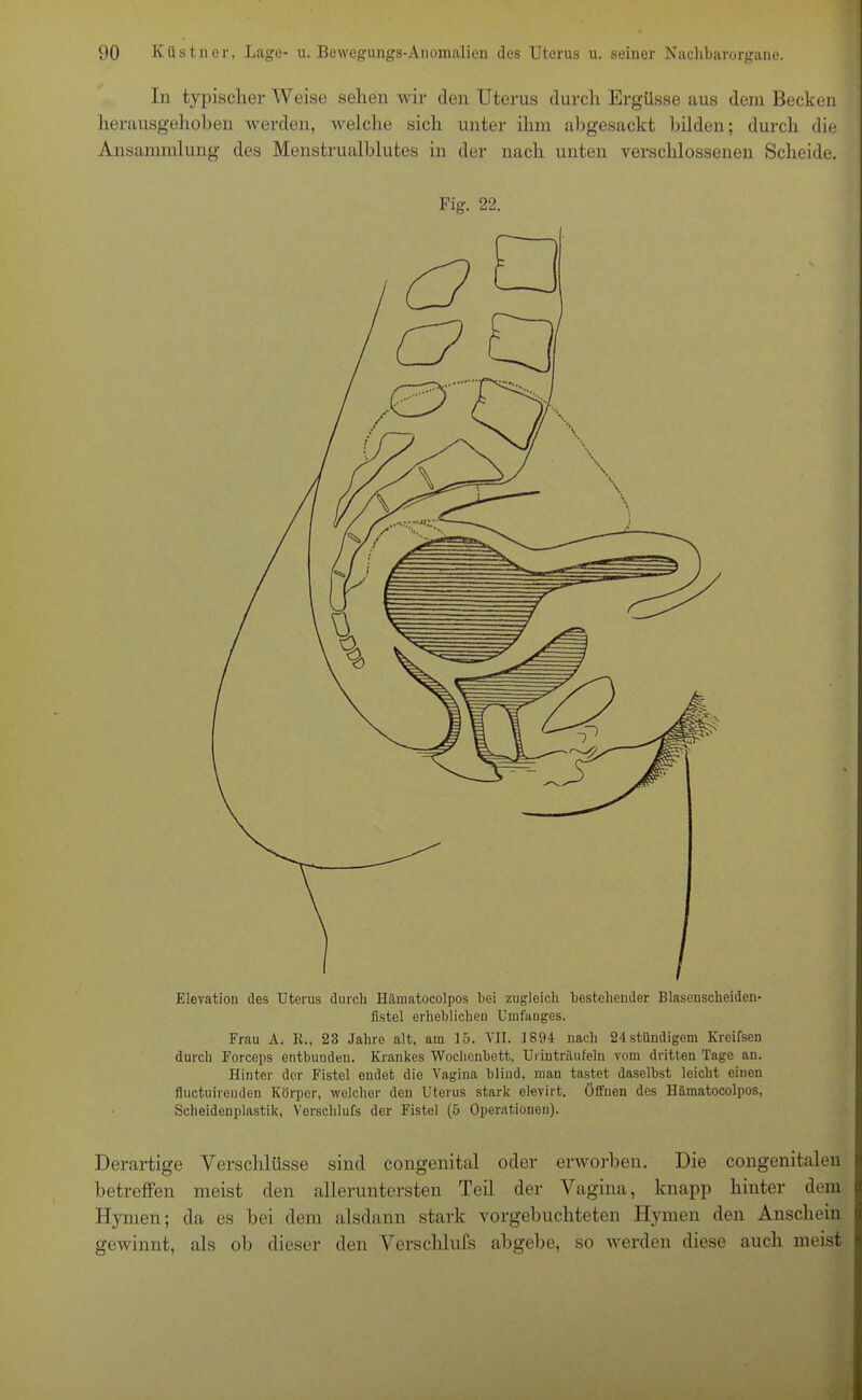 In typischer Weise sehen wir den Uterus durch Ergüsse aus dem Becken herausgehoben werden, welche sich unter ihm abgesackt bilden; durch die Ansammlung des Menstrualblutes in der nach unten verschlossenen Scheide. Fig. 22. Elevation des Uterus durch Hämatocolpos bei zugleich bestehender Blaseuscheiden- fistel erheblichen Umfanges. Frau A. R., 23 Jahre alt, am 15. VII. 1894 nach 24stündigem Kreifsen durch Forceps entbunden. Krankes Wochenbett, Urinträufeln vom dritten Tage an. Hinter der Fistel endet die Vagina blind, man tastet daselbst leicht einen fluctuirenden Körper, welcher den Uterus stark elevirt. Offnen des Hämatocolpos, Scheidenplastik, Verschlufs der Fistel (5 Operationen). Derartige Verschlüsse sind congenital oder erworben. Die congenitalen betreffen meist den alleruntersten Teil der Vagina, knapp hinter dem Hymen; da es bei dem alsdann stark vorgebuchteten Hymen den Anschein gewinnt, als ob dieser den Versclilufs abgebe, so werden diese auch meist