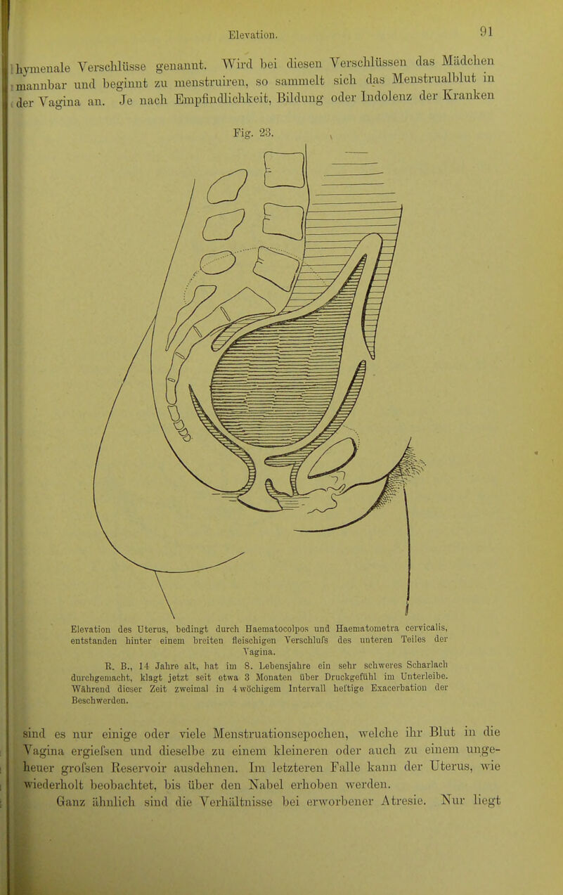 liymenale Verschlüsse genannt. Wird bei diesen Verschlüssen das Mädchen mannbar und beginnt zu menstruiren, so sammelt sich das Menstrualblut m der Vagina an. Je nach Empfindlichkeit, Bildung oder Indolenz der Kranken Fig. 23. Elevation des Uterus, bedingt durch Haematocolpos und Haematometra cervicalis, entstanden hinter einem breiten fleischigen Verschlufs des unteren Teiles der Vagina. K. B., 14 Jahre alt, hat im 8. Lebensjahre ein sehr schweres Scharlach durchgemacht, klagt jetzt seit etwa 3 Monaten über Druckgefühl im Unterleibe. Während dieser Zeit zweimal in 4 wöchigem Intervall heftige Exacerbation der Beschwerden. sind es nur einige oder viele Menstruationsepochen, welche ihr Blut in die Vagina ergiefsen und dieselbe zu einem kleineren oder auch zu einem unge- heuer grofsen Reservoir ausdehnen. Im letzteren Falle kann der Uterus, wie wiederholt beobachtet, bis über den Nabel erhoben werden. Ganz ähnlich sind die Verhältnisse bei erworbener Atresie. Nur liegt