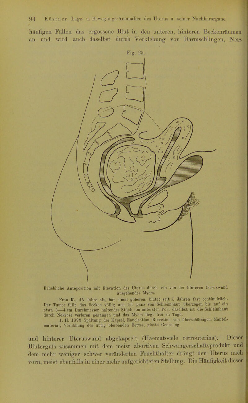 häufigen Fällen clas ergossene Blut in den unteren, hinteren Beckenräumen an und wird auch daselbst durch Verklebung von Darmschlingen, Netz Fig. 25. Erhebliche Anteposition mit Elevation des Uterus durch ein von der hinteren Cervixwand ausgehendes Myom. Frau K., 45 Jahre alt, hat 4mal geboren, blutet seit 5 Jahren fast contiuuirlich. Der Tumor füllt das Recken völlig aus, ist ganz von Schleimhaut überzogen bis auf ein etwa 3—4 cm Durchmesser haltendes Stück am untersten Pol; daselbst ist die Schleimhaut durch Nekrose verloren gegangen und das Myom liegt frei zu Tage. 1. II. 1893 Spaltung der Kapsel, Enucleation, llesection von überschüssigem Mantel- material, Vernähung des übrig bleibenden Bettes, glatte Genesung. und hinterer Uterus wand abgekapselt (Haematocele retrouterina). Dieser Blutergufs zusammen mit dem meist abortiven Schwangerschaftsprodukt und dem mehr weniger schwer veränderten Fruchthalter drängt den Uterus nach vorn, meist ebenfalls in einer mehr aufgerichteten Stellung. Die Häufigkeit dieser