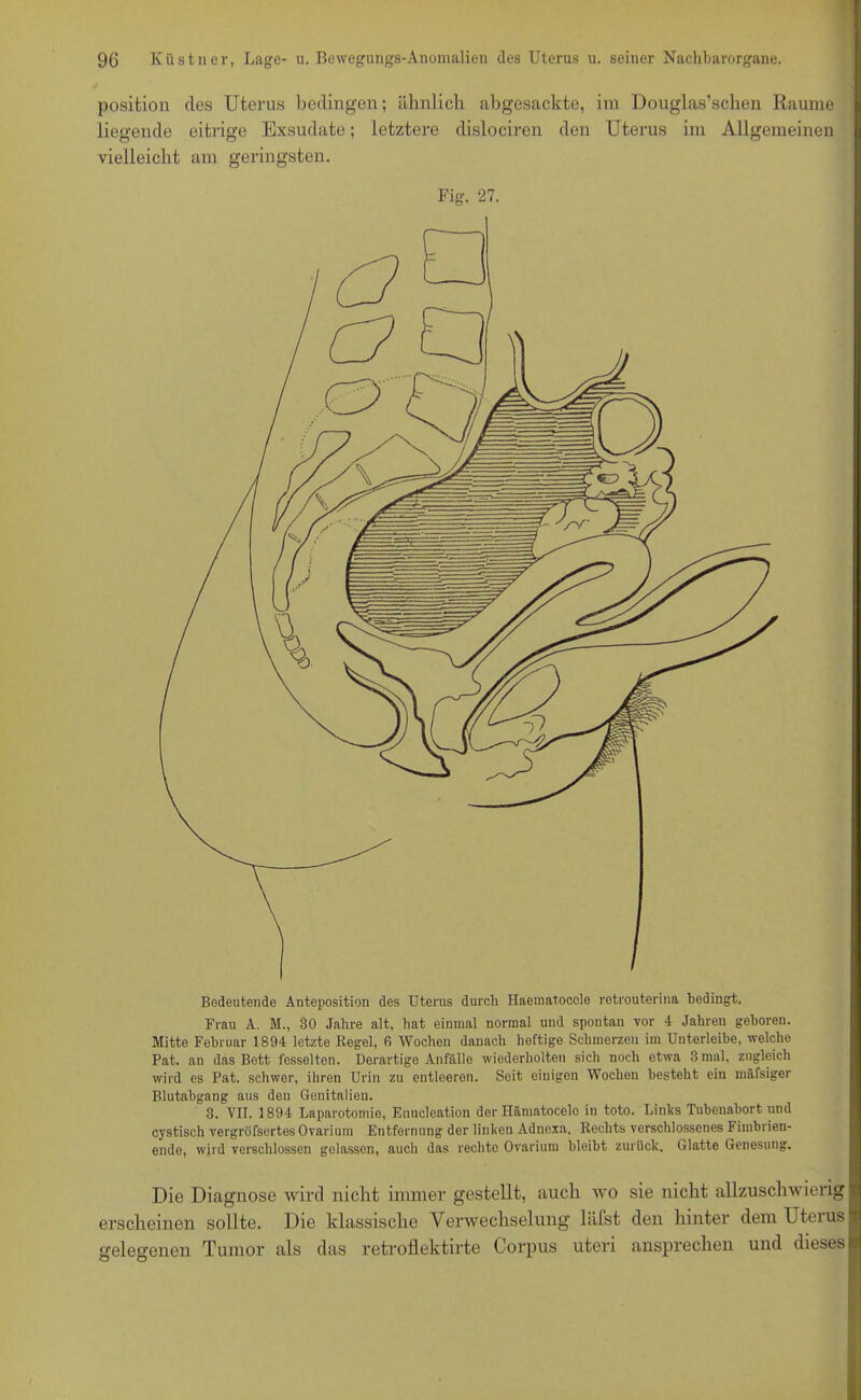 Position des Uterus bedingen; ähnlich abgesackte, im Douglas’schen Raume liegende eitrige Exsudate; letztere dislociren den Uterus im Allgemeinen vielleicht am geringsten. Fig. 27. Bedeutende Anteposition des Uterus durch Haematocole retrouterina bedingt. Frau A. M., 30 Jahre alt, hat einmal normal und spontan vor 4 Jahren geboren. Mitte Februar 1894 letzte Regel, 6 Wochen danach heftige Schmerzen im Uutorleibe, welche Pat. an das Bett fesselten. Derartige Anfälle wiederholten sich noch etwa 3 mal, zugleich wird cs Pat. schwer, ihren Urin zu eutleeren. Seit einigen Wochen besteht ein mäfsiger Blutabgang aus den Genitalien. 3. VII. 1894 Laparotomie, Enucleation der Hämatocele in toto. Links Tubenabort und cystisch vergröfsertes Ovarium Entfernung der linken Adnexa. Rechts verschlossenes Fimbrien- ende, wird verschlossen gelassen, auch das rechte Ovarium bleibt zurück. Glatte Genesung. Die Diagnose wird nicht immer gestellt, auch avo sie nicht allzuschwierig erscheinen sollte. Die klassische Verwechselung liifst den hinter dem Uteius gelegenen Tumor als das retroflektirte Corpus uteri ansprechen und dieses
