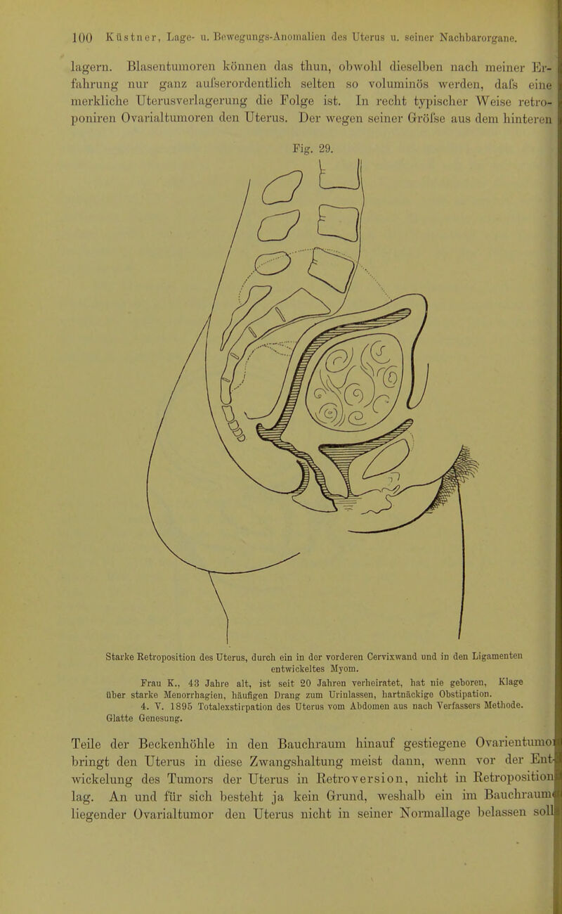 Starke Retroposition des Uterus, durch ein in dor vorderen Cervixwand und in den Ligamenten entwickeltes Myom. Frau K., 43 Jahre alt, ist seit 20 Jahren verheiratet, hat nie geboren, Klage über starke Menorrhagien, häufigen Drang zum Urinlassen, hartnäckige Obstipation. 4. Y. 1895 Totalexstirpation des Uterus vom Abdomen aus nach Verfassers Methode. Glatte Genesung. Teile der Beckenhöhle in den Bauchraum hinauf gestiegene Ovarientumoi bringt den Uterus in diese Zwangshaltung meist dann, wenn vor der Ent wickelung des Tumors der Uterus in RetroVersion, nicht in Retroposition lag. An und für sich besteht ja kein Grund, weshalb ein im Bauchraum» liegender Ovarialtumor den Uterus nicht in seiner Normallage belassen soll lagern. Blasentumoren können das thun, obwohl dieselben nach meiner Er- fahrung nur ganz aufserordentlich selten so voluminös werden, dafs eine merkliche Uterusverlagerung die Folge ist. In recht typischer Weise retro- poniren Ovarialtumoren den Uterus. Der wegen seiner Grölse aus dem hinteren Fig. 29.