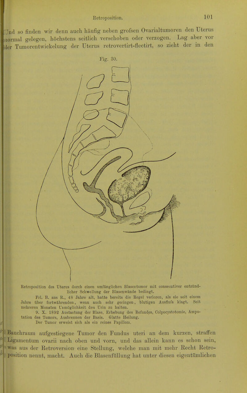 Jnd so finden wir denn auch häufig neben grofsen Ovarialtumoren den Uterus normal gelegen, höchstens seitlich verschoben oder verzogen. Lag aber vol- ler Tumorentwickelung der Uterus retrovertirt-flectirt, so zieht der in den Fig. 30. Retroposition des Uterus durch einen umfänglichen Blasentumor mit consecutiver entzünd- licher Schwellung der Blasenwände bedingt. Frl. B. aus R., 48 Jahre alt, hatte bereits die Regel verloren, als sie seit einem Jahre über fortwährenden, wenn auch sehr geringen, blutigen Ausflufs klagt. Seit mehreren Monaten Unmöglichkeit deu Urin zu halten. 9. X. 1892 Austastung dor Blase, Erhebung des Befundes, Colpocystotomie, Ampu- tation des Tumors, Ausbrennen der Basis. Glatte Heilung, j! Der Tumor erweist sich als ein reines Papillom. jl'- I Bauchraum auf gestiegene Tumor den Fundus uteri an dem kurzen, straffen Ligamentum ovarii nach oben und vorn, und das allein kann es schon sein, was aus der Retroversion eine Stellung, welche man mit mehr Recht Retro- position nennt, macht. Auch die Blasenfüllung hat unter diesen eigentümlichen