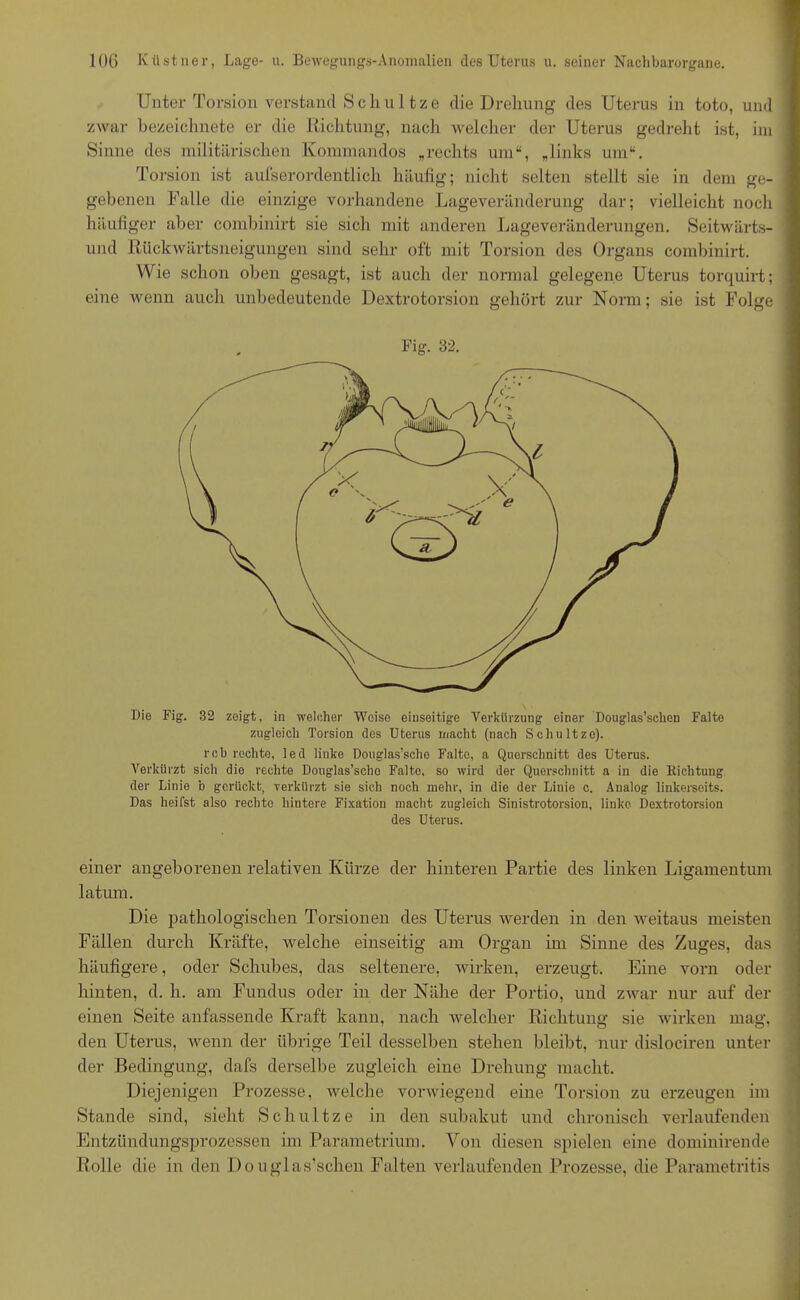Unter Torsion verstand Schnitze die Drehung des Uterus in tote, und zwar bezeichnete er die Richtung, nach -welcher der Uterus gedreht ist, im Sinne des militärischen Kommandos „rechts um“, „links um“. Torsion ist aufs er ordentlich häufig; nicht selten stellt sie in dem ge- gebenen Falle die einzige vorhandene Lageveränderung dar; vielleicht noch häufiger aber combinirt sie sich mit anderen Lageveränderungen. Seitwärts- und Rückwärtsneigungen sind sehr oft mit Torsion des Organs combinirt. Wie schon oben gesagt, ist auch der normal gelegene Uterus torquirt; eine wenn auch unbedeutende Dextrotorsion gehört zur Norm; sie ist Folge Fig. 32. Die Fig. 32 zeigt, in welcher Weise einseitige Verkürzung einer Douglas’sclien Falte zugleich Torsion des Uterus macht (nach Schultze). reb rechte, led linke Douglas’sche Falte, a Querschnitt des Uterus. Verkürzt sich die rechte Douglas’sclio Falte, so wird der Querschnitt a in die Richtung der Linie ’d gerückt, verkürzt sie sich noch mehr, in die der Linie c. Analog linkerseits. Das heilst also rechto hintere Fixation macht zugleich Sinistrotorsion, linke Dextrotorsion des Uterus. einer angeborenen relativen Kürze der hinteren Partie des linken Ligamentum latum. Die pathologischen Torsionen des Uterus werden in den weitaus meisten Fällen durch Kräfte, welche einseitig am Organ im Sinne des Zuges, das häufigere, oder Schubes, das seltenere, wirken, erzeugt. Eine vorn oder hinten, d. h. am Fundus oder in der Nähe der Portio, und zwar nur auf der einen Seite anfassende Kraft kann, nach welcher Richtung sie wirken mag, den Uterus, wenn der übrige Teil desselben stehen bleibt, nur dislociren unter der Bedingung, dafs derselbe zugleich eine Drehung macht. Diejenigen Prozesse, welche vorwiegend eine Torsion zu erzeugen im Stande sind, sieht Schultze in den subakut und chronisch verlaufenden Entzündungsprozessen im Parametrium. Von diesen spielen eine dominirende Rolle die in den Douglas’schen Falten verlaufenden Prozesse, die Parametritis