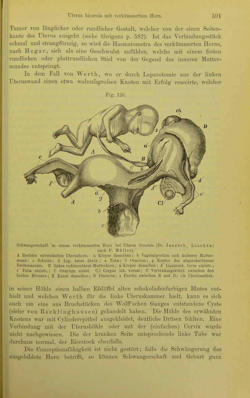 Tumor von länglicher oder rundlicher Gestalt, welcher von der einen Seiten- kante des Uterus ausgeht (siehe übrigens p. 582). Ist das Verbindungsstück schmal und strangförmig, so wird die Ilaematometra des verkümmerten Horns, nach He gar, sich als eine Geschwulst anfühlen, welche mit einem festen rundlichen oder plattrundlichen Stiel von der Gegend des inneren Mutter- mundes entspringt. In dem Fall von Werth, wo er durch Laparotomie aus der linken Uteruswand einen etwa walnufsgrofsen Knoten mit Erfolg resecirte, welcher Fig. 126. Schwangerschaft in einem verkümmerten Horn hei Uterus hicornis (Dr. Jaensch, Luschka; nach P. Müller). A Rechtes entwickeltes Uterushorn, a Körper desselben; b Vagitmlportion und äufserer Mutter- mund ; c Scheide; d Lig. teres dextr.; e Tuba; f Ovarium; g Kontur des abgeschnittenen Peritonaeums. B linkes rudimentäres Mutterhorn; a Körper desselben; d’ Ligament, teres sinistr.; c Tuba sinistr.; f ’ Ovarium sinist. C.l Corpus lut. verum; C Verbindungsstück zwischen den beiden Hörnern; K Kanal desselben; D Placonta; s Furcho zwischen B und D; ch Chorionstück. in seiner Höhle einen halben EfslöfFel alten schokoladenfarbigen Blutes ent- hielt und welchen Werth für die linke Uteruskammer hielt, kann es sich auch um eine aus Bruchstücken des Wolffschen Ganges entstandene Cyste (siehe von Recklinghausen) gehandelt haben. Die Höhle des erwähnten Knotens war mit Cylinderepithel ausgekleidet, deutliche Drüsen fehlten. Eine Verbindung mit der Uterushöhle oder mit der (einfachen) Cervix wurde nicht nachgewiesen. Die der kranken Seite entsprechende linke Tube war durchaus normal, der Eierstock ebenfalls. Die Conceptionsfähigkeit ist nicht gestört; falls die Schwängerung das ausgebildete Horn betrifft, so können Schwangerschaft und Geburt ganz