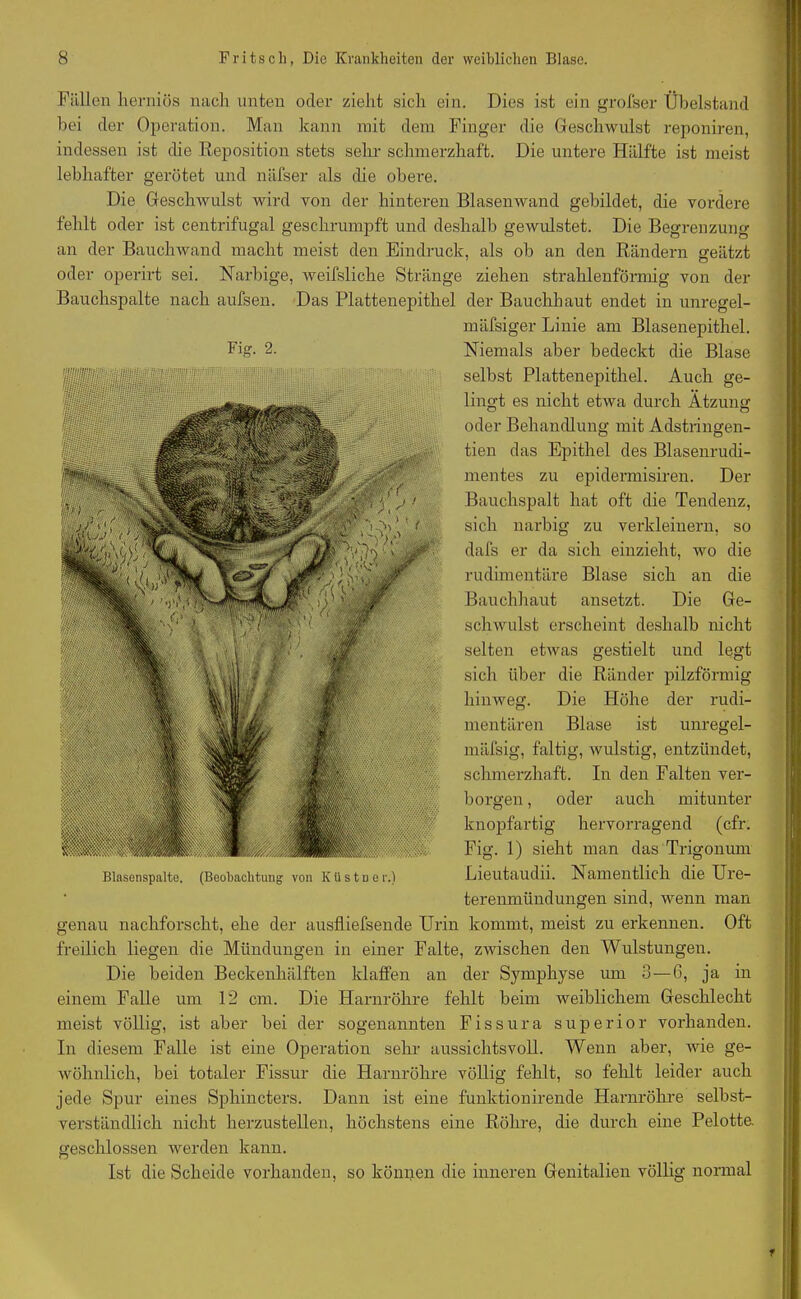 . Fällen herniös nach unten oder zieht sich ein. Dies ist ein grofser Übelstand bei der Operation. Man kann mit dem Finger die Geschwulst reponiren, indessen ist die Reposition stets sehr schmerzhaft. Die untere Hälfte ist meist lebhafter gerötet und näfser als die obere. Die Geschwulst wird von der hinteren Blasenwand gebildet, die vordere fehlt oder ist centrifugal geschrumpft und deshalb gewulstet. Die Begrenzung an der Bauchwand macht meist den Eindruck, als ob an den Rändern geätzt oder operirt sei. Narbige, weifslicke Stränge ziehen strahlenförmig von der Bauchspalte nach aufsen. Das Plattenepithel der Bauchhaut endet in unregel- mäfsiger Linie am Blasenepithel. Fig- 2. Niemals aber bedeckt die Blase selbst Plattenepithel. Auch ge- lingt es nicht etwa durch Ätzung oder Behandlung mit Adstringen- tien das Epithel des Blasenrudi- mentes zu epidermisiren. Der Bauchspalt hat oft die Tendenz, sich narbig zu verkleinern, so dafs er da sich einzieht, wo die rudimentäre Blase sich an die Bauchhaut ansetzt. Die Ge- schwulst erscheint deshalb nicht selten etwas gestielt und legt sich über die Ränder pilzförmig hinweg. Die Höhe der rudi- mentären Blase ist unregel- mäfsig, faltig, wulstig, entzündet, schmerzhaft. In den Falten ver- borgen , oder auch mitunter knopfartig hervorragend (cfr. Fig. 1) sieht man das 'Trigonuni Lieutaudii. Namentlich die Ure- terenmündungen sind, wenn man genau nachforscht, ehe der ausfliefsende Urin kommt, meist zu erkennen. Oft freilich liegen die Mündungen in einer Falte, zwischen den Wulstungen. Die beiden Beckenhälften klaffen an der Symphyse um 3 — 6, ja in einem Falle um 12 cm. Die Harnröhre fehlt beim weiblichem Geschlecht meist völlig, ist aber bei der sogenannten Fissura superior vorhanden. In diesem Falle ist eine Operation sehr aussichtsvoll. Wenn aber, wie ge- wöhnlich, bei totaler Fissur die Harnröhre völlig fehlt, so fehlt leider auch jede Spur eines Spkincters. Dann ist eine funktionirende Harnröhre selbst- verständlich nicht herzustellen, höchstens eine Röhre, die durch eine Pelotte. geschlossen werden kann. Ist die Scheide vorhanden, so können die inneren Genitalien völlig normal Blasenspalte. (Beobachtung von K U s t u e r.) f