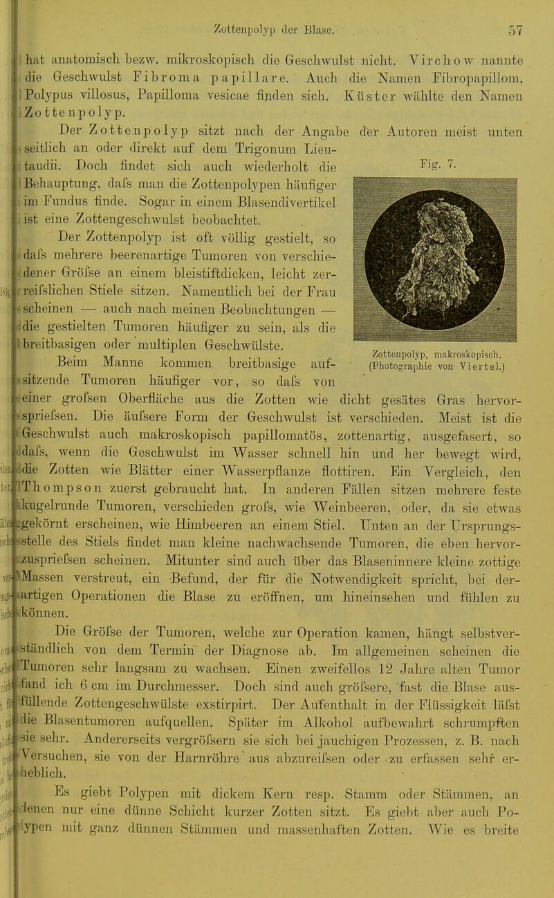 Fig. 7. Zottenpolyp, makroskopisch. (Photographie von Viertel.) hat anatomisch bezAv. mikroskopisch die Geschwulst nicht. Virchow nannte die Geschwulst Fibroma papillare. Auch die Namen Fibropapillom, Polypus villosus, Papilloma vesicae finden sich. Küster wählte den Namen Zottenpolyp. Der Zottenpolyp sitzt nach der Angabe der Autoren meist unten -seitlich an oder direkt auf dem Trigonum Lieu- taudii. Doch findet sich auch wiederholt die ! Behauptung, dafs man die Zottenpolypen häufiger im Fundus finde. Sogar in einem Blasendivertikel ist eine Zottengeschwulst beobachtet. Der Zottenpolyp ist oft völlig gestielt, so dafs mehrere beerenartige Tumoren von verschie- dener Gröfse an einem bleistiftdicken, leicht zer- Hl! r reifslicken Stiele sitzen. Namentlich bei der Frau -scheinen — auch nach meinen Beobachtungen — die gestielten Tumoren häufiger zu sein, als die i breitbasigen oder multiplen Geschwülste. Beim Manne kommen breitbasige auf- sitzende Tumoren häufiger vor, so dafs von i einer grofsen Oberfläche aus die Zotten wie dicht gesätes Gras hervor- spriefsen. Die äufsere Form der Geschwulst ist verschieden. Meist ist die 'Geschwulst auch makroskopisch papillomatös, zottenartig, ausgefasert, so ■dafs, wenn die Geschwulst im Wasser schnell hin und her bewegt wird, iie« (die Zotten wie Blätter einer Wasserpflanze flottiren. Ein Vergleich, den Thompson zuerst gebraucht hat. In anderen Fällen sitzen mehrere feste kkugelrunde Tumoren, verschieden grofs, Avie Weinbeeren, oder, da sie etwas a .gekörnt erscheinen, Avie Himbeeren an einem Stiel. Unten an der Ursprungs- istk - stelle des Stiels findet man kleine nachwachsende Tumoren, die eben hervor- zuspriefsen scheinen. Mitunter sind auch über das Blasen innere kleine zottige Massen verstreut, ein Befund, der für die Notwendigkeit spricht, bei der- cjj- (artigen Operationen che Blase zu eröffnen, um hineinsehen und fühlen zu jsd > können. Die Gröfse der Tumoren, welche zur Operation kamen, hängt selbstver- ständlich von dem Termin der Diagnose ab. Im allgemeinen scheinen die sch I Tumoren sehr langsam zu wachsen. Einen zweifellos 12 Jahre alten Tumor fand ich 6 cm im Durchmesser. Doch sind auch gröfsere, fast die Blase aus- 'füllende Zottengeschwülste exstirpirt. Der Aufenthalt in der Flüssigkeit läfst die Blasentumoren aufquellen. Später im Alkohol aufbewahrt schrumpften sie sehr. Andererseits vergröfsern sie sich bei jauchigen Prozessen, z. B. nach rot Versuchen, sie von der Harnröhre aus abzureifsen oder zu erfassen sehr er- heblich. Es giebt Polypen mit dickem Kern resp. Stamm oder Stämmen, an lenen nur eine dünne Schicht kurzer Zotten sitzt. Es giebt aber auch Po- fypen mit ganz dünnen Stämmen und massenhaften Zotten. Wie es breite fei 0 iiifl m re'