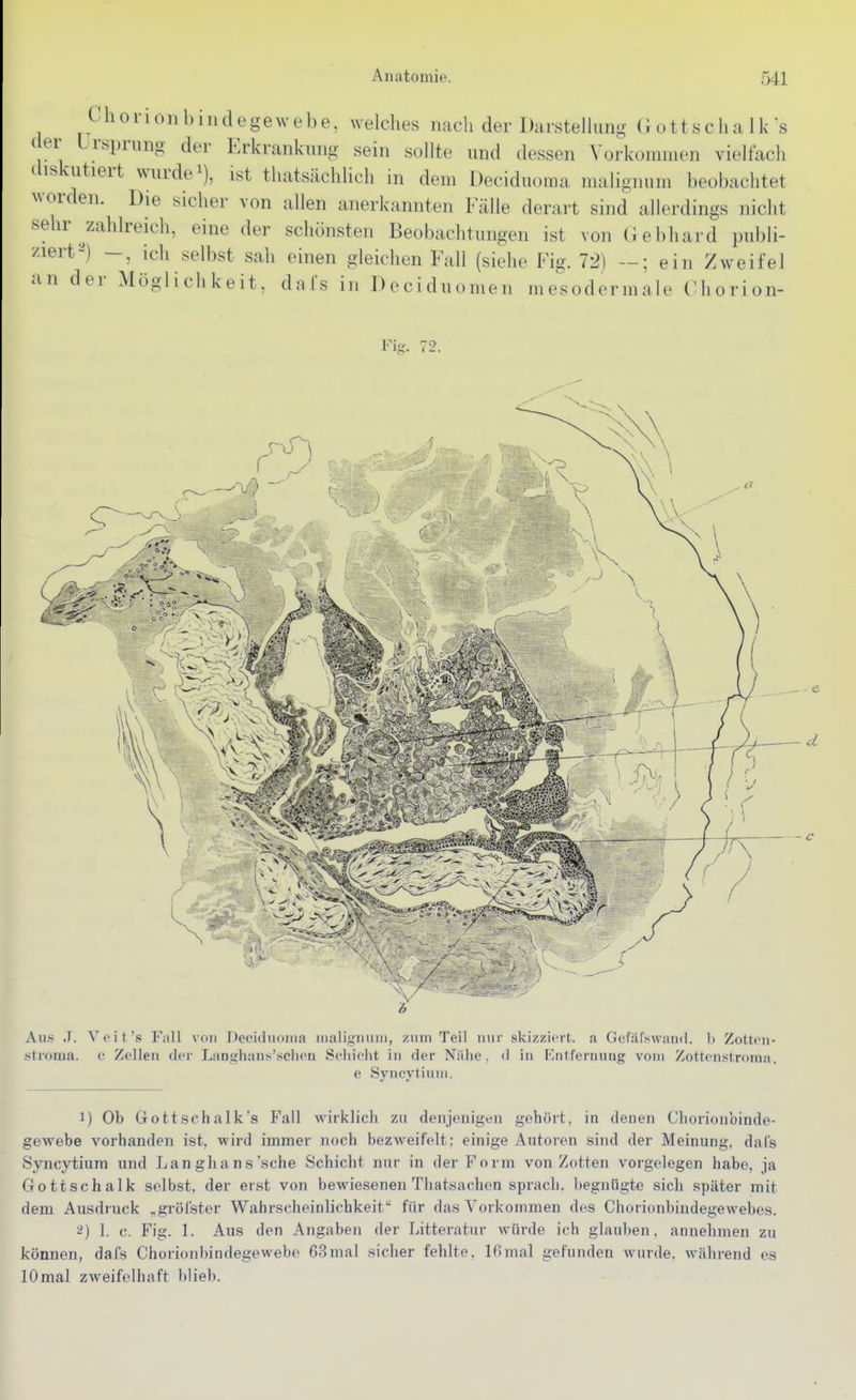 C horionbindegewebe, welches nach der Darstelhmg Gottschalk's ( er Lrsprung der Erkrankung sein sollte und dessen Vorkommen vielfach diskutiert wurdet), ist tliatsächlich in dem Deciduoma malignum beobachtet worden. Die sicher von allen anerkannten Fälle derart sind allerdings nicht •sehr zahlreich, eine der schönsten Beobachtungen ist von Gebhard publi- ziert-) —, ich selbst sah einen gleichen Fall (siehe Fig. 72) —; ein Zweifel an der Möglichkeit, dafs in Deciduomen mesodermale Chorion- Fig. 72. e Syncytiuin. 1) Ob Gottschalk's Fall wirklich zu denjenigen gehört, in denen Chorionbinde- gewebe vorhanden ist, wird immer noch bezweifelt; einige Autoien sind der Meinung, dafs Syncytium und Lan ghans'sehe Schicht nur in der Form von Zotten vorgelegen habe, ja Gottschalk selbst, der erst von bewiesenen Thatsachen spi-ach. begnügte sich später mit dem Ausdruck „gröfster Wahrscheinlichkeit für das Vorkommen des Chorionbiudegewebes. ^) 1. c. Fig. 1. Aus den Angaben der Litteratur würde ich glauben, annehmen zu können, dafs Chorionbindegewebe 63mal sicher fehlte. Ißmal gefunden wurde, während es 10mal zweifelhaft blieb.