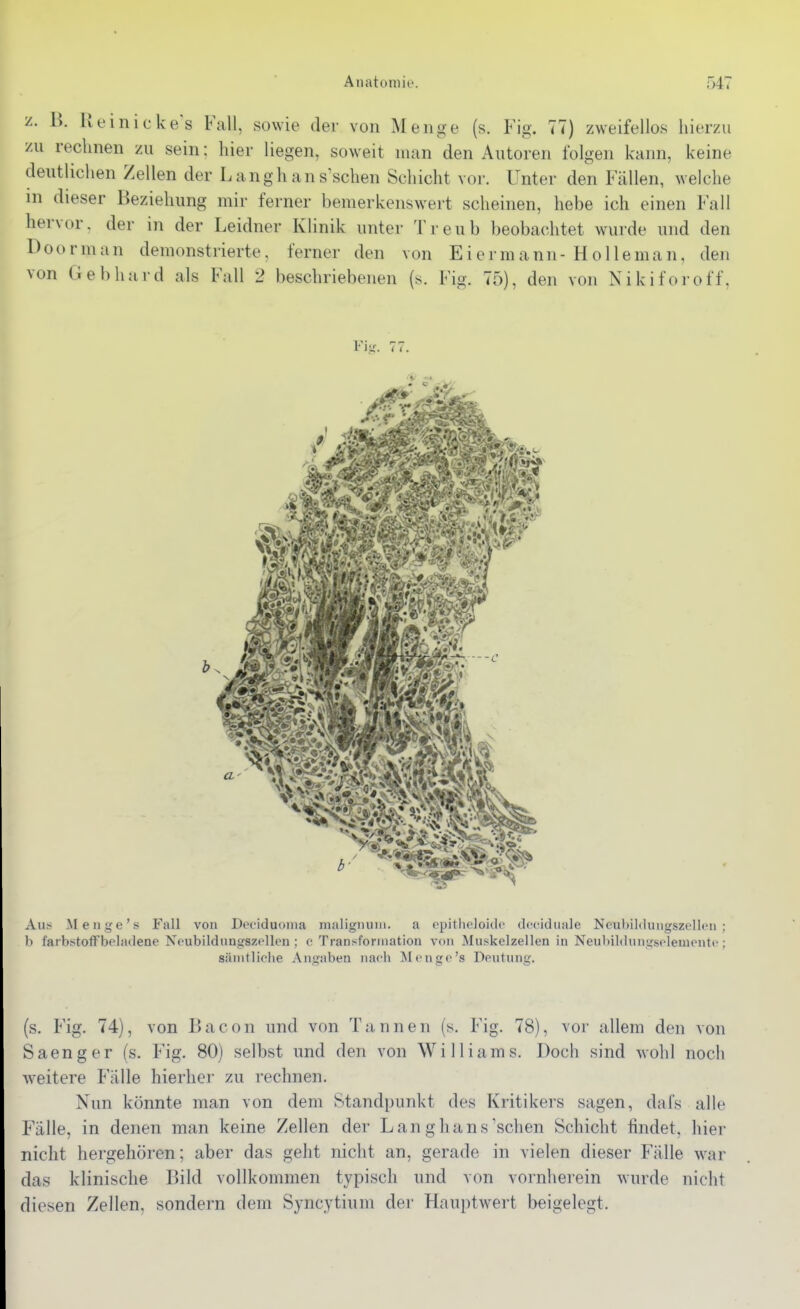 z. B. Ueinickes Fall, sowie der von Menge (s. Fig. 77) zweifellos hierzu zu rechnen zu sein: hier liegen, soweit man den Autoren folgen kann, keine deutliclien Zellen der Langh ans'schen Schicht vor. Unter den Fällen, Avelche m dieser Beziehung mir ferner bemerkenswert scheinen, hebe ich einen Fall hervor, der in der Leidner Klinik unter Treub beobachtet wurde und den Doorman demonstrierte, ferner den von Ei ermann-Holle man, den von Gebhard als Fall 2 beschriebenen (s. Fig. 75), den von Nikiforoff, Fiii. 7' .Vu> Menge's Fall von Deciduonia malignuiu. a opitlieJoido dccidiiale NeuWildungszollcn Ii farbstoffbeladene Ncubildungszfllcn ; ('Transformation von Muskelzellen in Neubildnngsplementc sämtliche Antraben nach Menge's Dcutnng. (s, Fig. 74), von Bacon und von Tannen (s. Fig. 78), vor allem den von Saenger (s. Fig. 80) selbst und den von Williams. Doch sind wohl noch weitere Fälle hierher zu rechnen. Nun könnte man von dem Standpunkt des Kritikers sagen, dafs alle Fälle, in denen man keine Zellen der Lan ghans'sehen Schicht findet, hier nicht hergehören; aber das geht nicht an, gerade in vielen dieser Fälle \var das klinische Bild vollkommen typisch und von vornherein wurde nicht diesen Zellen, sondern dem Syncytium der Hauptwert beigelegt.