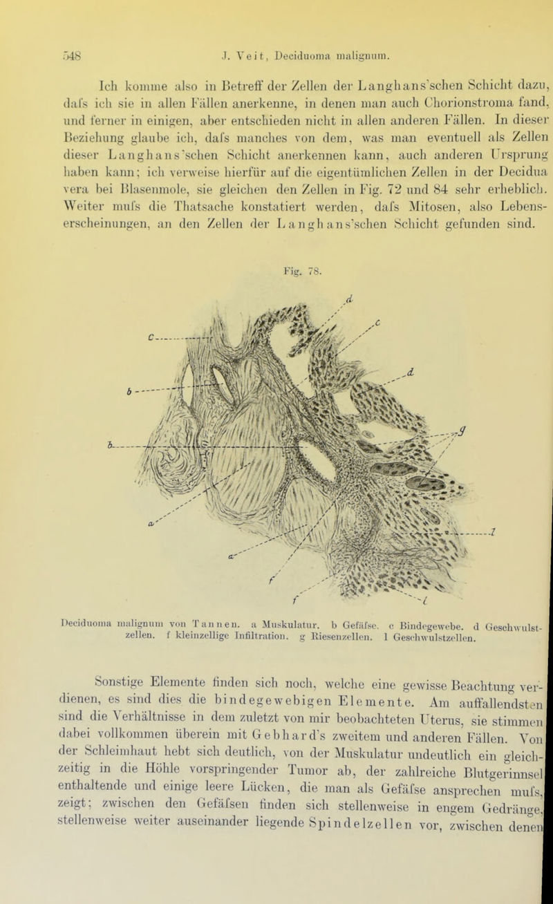 Ich küinme also in Betreff der Zellen der Langlians'schen Schicht dazu, dals ich sie in allen Fallen anerkenne, in denen man auch Chorionstroma fand, und fei-ner in einigen, aber entschieden niclit in allen anderen Fällen. In dieser Beziehung glaube ich, dal's manches von dem, was man eventuell als Zellen dieser Langhans sehen Schicht anerkennen kann, auch anderen Ursprung haben kann; ich verweise hierfür auf die eigentümlichen Zellen in der Decidua Vera bei Blasenmole, sie gleichen den Zellen in Fig. 72 und 84 sehr erheblich. Weiter mufs die Thatsache konstatiert werden, dafs Mitosen, also Lebens- erscheinungen, an den Zellen der L angh ans'schen Schicht gefunden sind. Fig. 78. Deciduoma iiialignuin von Tan neu. a Muskulatur, b Gefäfso. c Bindegewebe, d Geschwulst Zellen, f kleinzellige Infiltration, g Riesenzcllen. 1 GesdnvuIstzollen. Sonstige Elemente finden sich noch, welche eine gewisse Beachtung ver dienen, es sind dies die bindegewebigen Elemente. Am auffallendst.-i sind die Verhältnisse in dem zuletzt von mir beobachteten Uterus, sie stimmen dabei vollkommen überein mit Gebhardts zweitem und anderen Fällen. Von der Schleimhaut hebt sich deutlich, von der Muskulatur undeutlich ein gleich- zeitig in die Höhle vorspringender Tumor ab, der zahlreiche Blutgerinnsel enthaltende und einige leere Lücken, die man als Gefäfse ansprechen mufs. zeigt; zwischen den Gefäfsen linden sich stellenweise in engem Gedränge, stellenweise weiter auseinander liegende Spindelzellen vor, zwischen denen