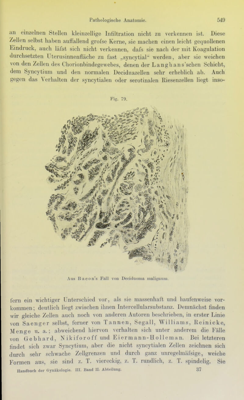 an einzelnen Stellen kleinzellige Inliltration nicht zu verkennen ist. Diese /eilen selbst haben auffallend grofse Kerne, sie machen einen leicht gequollenen Eindruck, auch läCst sich nicht verkennen, dafs sie nach der mit Koagulation durchsetzten Uterusinnenfläche zu fast „syncytial werden, aber sie weichen von den Zellen des Chorionbindegewebes, denen der Lang hansischen Schicht, dem Syncytium und den normalen Deciduazellen sehr erheblich ab. Auch gegen das Verhalten der syncytialen oder serotinalen Riesenzellen liegt inso- fern ein wichtiger Unterschied vor, als sie massenhaft und haufenweise vor- kommen; deutlich liegt zwischen ihnen Intercellularsubstanz. Demnächst finden wir gleiche Zellen auch noch von anderen Autoren beschrieben, in erster Linie von Saenger selbst, ferner von Tannen, Segall, Williams, Reinicke, Menge u. a.; abweichend hiervon verhalten sich unter anderem die Fälle von Gebhard, Nikiforoff und Eiermann-Holleman. Bei letzteren findet sich zwar Syncytium, aber die nicht syncytialen Zellen zeichnen sich durch sehr schwache Zellgrenzen und durch ganz unregelmäfsige, weiche Formen aus, sie sind z. T. viereckig, z. T. rundlich, z. T. spindelig. Sie Handbuch der Gynäkologie. III. Band II. Abteilung. 37