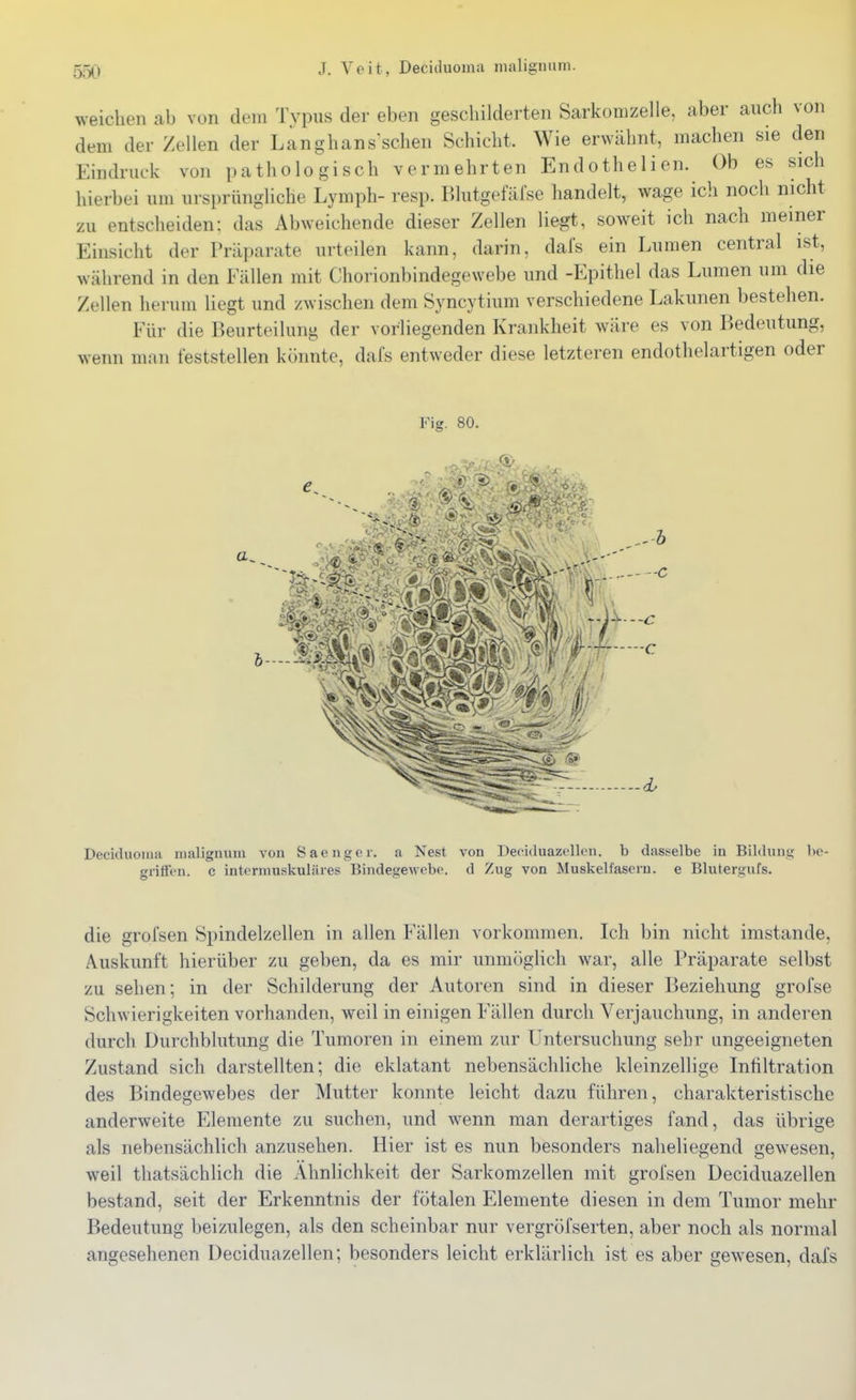 weichen ab von dem Typus der eben geschilderten Sarkomzelle, aber auch von dem der Zellen der Langhans'schen Schicht. Wie erwähnt, machen sie den Eindruck von pathologisch vermehrten Endothelien. Ob es sich hierbei um ursprüngliche Lymph- resp. Blutgefäfse handelt, wage ich noch nicht zu entscheiden: das Abweichende dieser Zellen liegt, soweit ich nach meiner Einsicht der Präparate urteilen kann, darin, dafs ein Lumen central ist, während in den Fällen mit Chorionbindegewebe und -Epithel das Lumen um die Zellen herum liegt und zwischen dem Syncytium verschiedene Lakunen bestehen. Für die Beurteilung der vorliegenden Krankheit wäre es von Bedeutung, wenn man feststellen könnte, dafs entweder diese letzteren endothelartigen oder Deciduonui malignum von Saenger, a Nest von Deciduazellen. b dasselbe in Bildung be- griffen, c intermuskuläres Bindegewebe, d Zug von Muskelfasern, e Blutergufs. die grofsen Spindelzellen in allen Fällen vorkommen. Ich bin nicht imstande, Auskunft hierüber zu geben, da es mir unmögHch war, alle Präparate selbst zu sehen; in der Schilderung der Autoren sind in dieser Beziehung grofse Schwierigkeiten vorhanden, weil in einigen Fällen durch Verjauchung, in anderen durch Durchblutung die Tumoren in einem zur Untersuchung sehr ungeeigneten Zustand sich darstellten; die eklatant nebensächliche kleinzellige Infiltration des Bindegewebes der Mutter konnte leicht dazu führen, charakteristische anderweite Elemente zu suchen, und Avenn man derartiges fand, das übrige als nebensächlich anzusehen. Hier ist es nun besonders naheliegend gewesen, weil thatsächlich die Ähnlichkeit der Sarkomzellen mit grofsen Deciduazellen bestand, seit der Erkenntnis der fötalen Elemente diesen in dem Tumor mehr Bedeutung beizulegen, als den scheinbar nur vergröfserten, aber noch als normal angesehenen Deciduazellen; besonders leicht erklärlich ist es aber gewesen, daXs