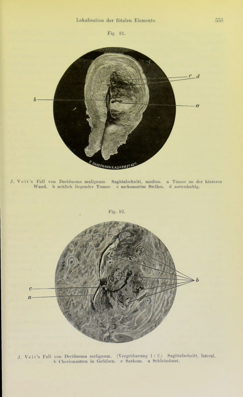 Fig. 81. J. Veit's Fall von Deciduoma malignuin. Sagittalschnitt, median, a Tumor an der hinteren Wand, b seitlieli liegender Tumor, c sarkomatöse Stellen, d zottenhaltig. Fig. 82. J. Veit's Fall von Deciduoma niolignum. (Vergröfserung 1:2.) Sagittalschnitt, lateral. )) Chorion/otten in Gefäfsen. c Sarkoni, a Sehleindiaut.