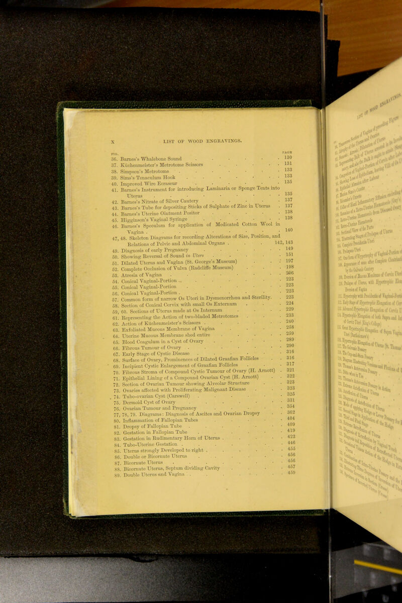 36. Barnes's Whalebone Sound 37. Kiichenmeister's Metrotome Scissors 38. Simpson's Metrotome . 39. Sims's Tenaculum Hook ... 40. Improved Wire Ecraseur 41. Barnes's Instrument for introducing Laminaria or Sponge Tents into Uterus 42. Barnes's Nitrate of Silver Cautery .... 43. Barnes's Tube for depositing Sticks of Sulphate of Zinc in Uterus 44. Barnes's Uterine Ointment Positor .... 45. Higginson's Vaginal Syringe ..... 46. Barnes's Speculum for application of Medicated Cotton Wool in Vagina . ■ • • • • * 47. 48. Skeleton Diagrams for recording Alterations of Size, Position, and Relations of Pelvic and Abdominal Organs . . .142 49. Diagnosis of early Pregnancy 50. Showing Reversal of Sound in Utero 51. Dilated Uterus and Vagina (St. George's Museum) 52. Complete Occlusion of Vulva (Radcliffe Museum) 53. Atresia of Vagina . 54. Conical Vaginal-Portion.. 55. Conical Vaginal-Portion . 56. Conical Vaginal-Portion . 57. Common form of narrow Os Uteri in Dysmenorrhcea and Sterility 58. Section of Conical Cervix with small Os Externum 59. 60. Sections of Uterus made at Os Internum 61. Representing the Action of two-bladed Metrotomes 62. Action of Ktichenmeister's Scissors . 63. Exfoliated Mucous Membrane of Vagina 64. Uterine Mucous Membrane shed entire 65. Blood Coagulum in a Cyst of Ovary . • • • 66. Eibrous Tumour of Ovary . 67. Early Stage of Cystic Disease . . • 68. Surface of Ovary, Prominences of Dilated Graafian Follicles 69. Incipient Cystic Enlargement of Graafian Follicles 70. Fibrous Stroma of Compound Cystic Tumour of Ovary (H. Arnott) 71. Epithelial Lining of a Compound Ovarian Cyst (H. Amott) 72. Section of Ovarian Tumour showing Alveolar Structure 73. Ovaries affected with Proliferating Malignant Disease 74. Tubo-ovarian Cyst (Carswell) .... 75. Dennoid Cyst of Ovary . . 76. Ovarian Tumour and Pregnancy 77. 78, 79. Diagrams: Diagnosis of Ascites and Ovarian Dropsy 80. Inflammation of Fallopian Tubes 81. Dropsy of Fallopian Tube 82. Gestation in Fallopian Tube 83. Gestation in Rudimentary Horn of Uterus 84. Tubo-Uterino Gestation . 85. Uterus strongly Developed to right . 86. Double or Bicornuto Uterus 87. Bicornute Uterus 88. Bicornute Uterus, Septum dividing Cavity 89. Double Uterus end Vagina . •AGE 130 131 133 133 135 135 137 137 138 138 140 , 143 149 151 197 198 206 223 223 223 223 224 229 233 240 258 259 289 290 316 316 317 321 322 323 323 325 331 354 362 404 409 419 422 446 455 456 456 457 459 off Effi .Unstinting1 id by the Galvanic Cauttn- • ' ' 10S. Erasion of Mucous Jtoionuio of ftnu Flfti 110. Prolapse o/ Uterus, will HjprtqpHfl Aim Erera'oD of Vagina . 111, HVpertrophr Tritli ProcitJpiitid of Vaii'iiid-i'iirii HiEsrlrStajeof HvffUnijiliic Hnnyjlinn of (Vn 113, Adranced Hjpcrtrophic Hmprtion of (Vni\ I 1H. HyperfrophieElongation of LoHi Supra J(i,d |„| of Unix Uteri (King's CAjre) The Cm>; HS.Dk! ad-Stem ?^ JBral^ eruj mi 128, l'!S,