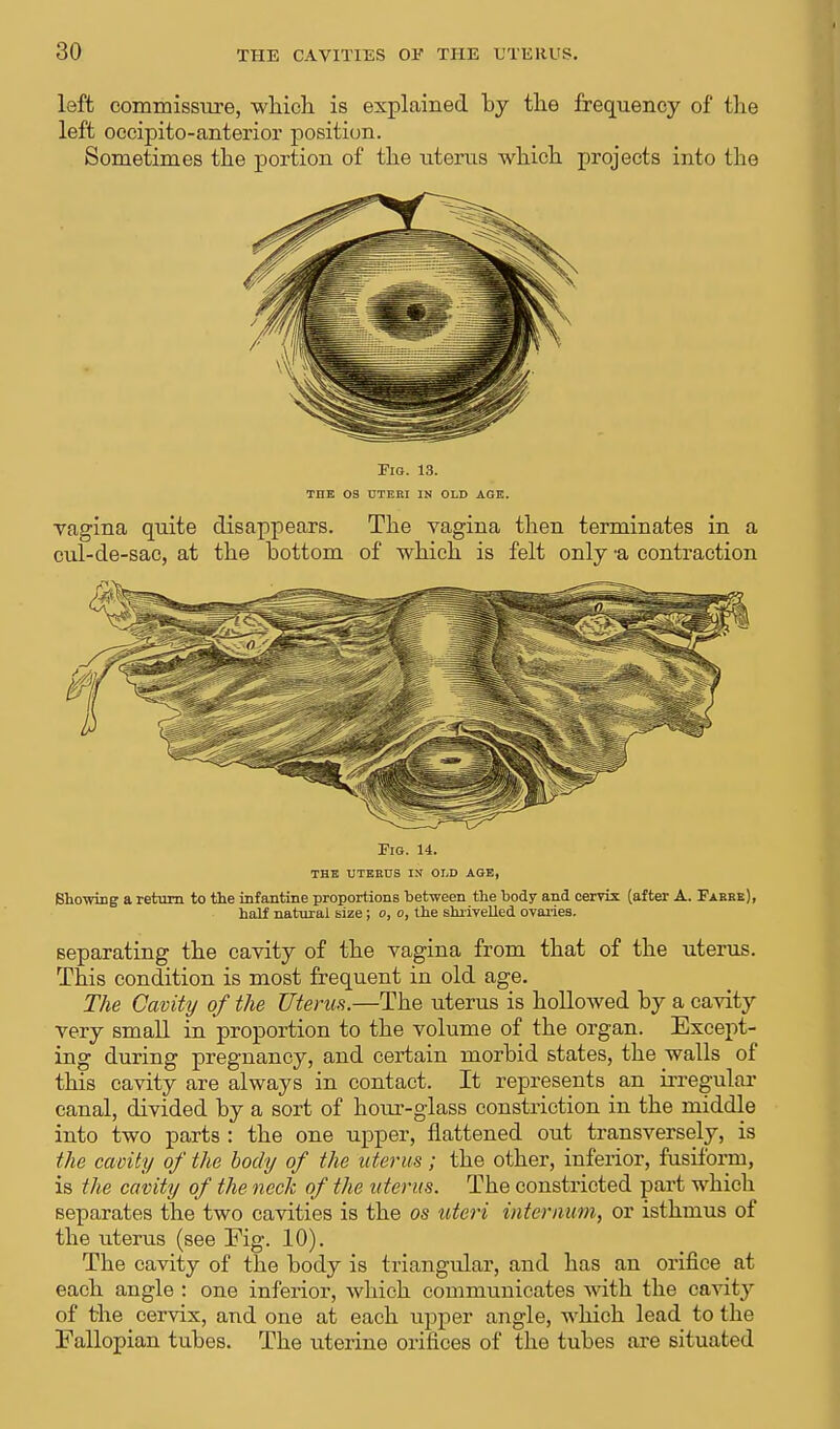left commissure, which is explained by the frequency of the left occipitoanterior position. Sometimes the portion of the uterus which projects into the Fig. 14. the uterus in old age, Showing a return to the infantine proportions between the body and cervix (after A. Eaeee), half natural size ; o, o, the shrivelled ovaries. separating the cavity of the vagina from that of the uterus. This condition is most frequent in old age. The Cavity of the Uterus.—The uterus is hollowed by a cavity very small in proportion to the volume of the organ. Except- ing during pregnancy, and certain morbid states, the walls of this cavity are always in contact. It represents an irregular canal, divided by a sort of hour-glass constriction in the middle into two parts : the one upper, flattened out transversely, is the cavity of the body of the uterus; the other, inferior, fusiform, is the cavity of the neck of the uterus. The constricted part which separates the two cavities is the os uteri internum, or isthmus of the uterus (see Fig. 10). The cavity of the body is triangular, and has an orifice at each angle : one inferior, which communicates with the cavity of the cervix, and one at each upper angle, which lead to the Fallopian tubes. The uterine orifices of the tubes are situated