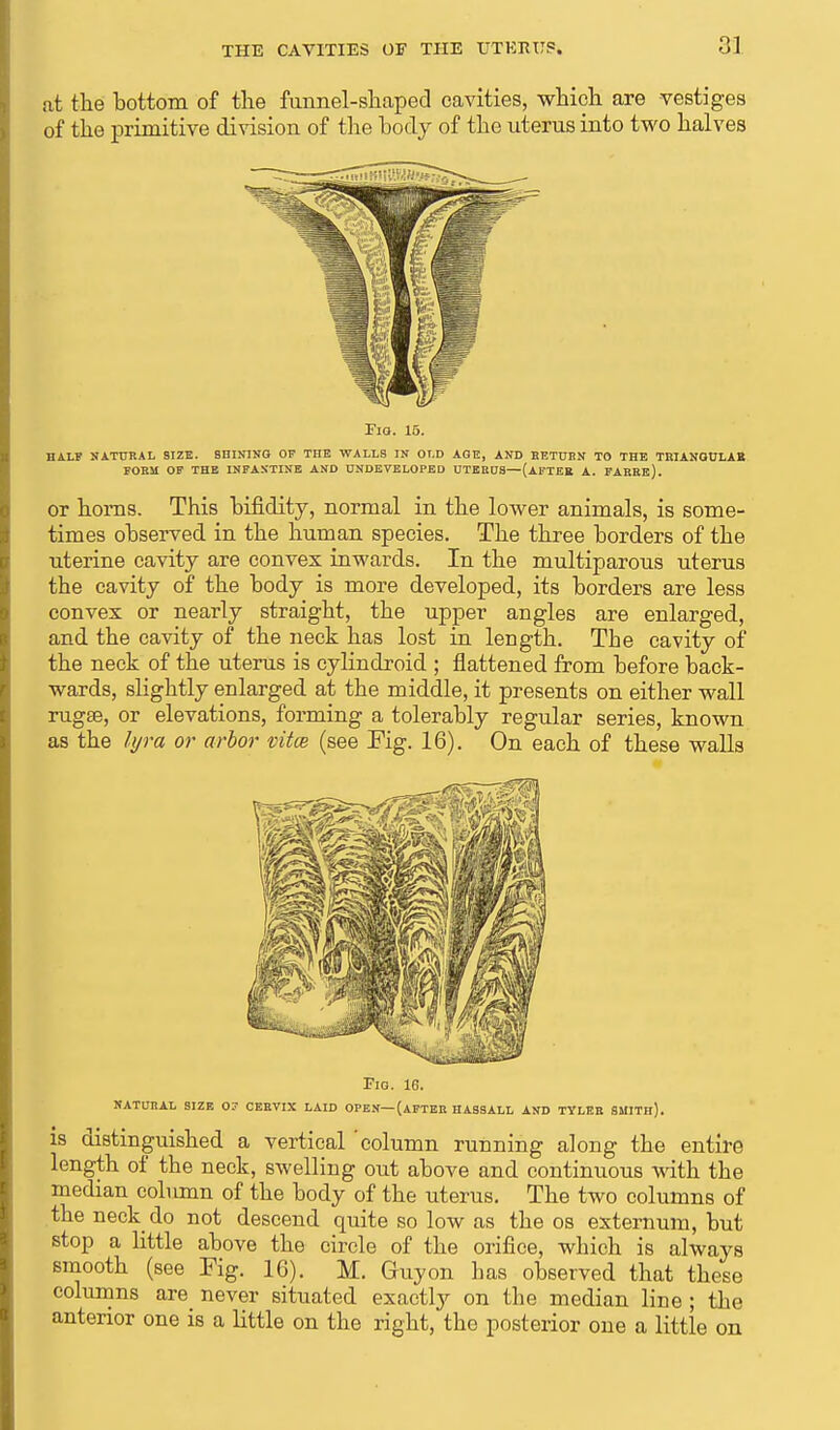 at the bottom of the funnel-shaped cavities, which are vestiges of the primitive division of the body of the uterus into two halves Pig. 15. half natural size. shining of the walls in old age, and betubn to the triangular form of the infantine and undeveloped uterus—(after a. farre). or homs. This bifidity, normal in the lower animals, is some- times observed in the human species. The three borders of the uterine cavity are convex inwards. In the multiparous uterus the cavity of the body is more developed, its borders are less convex or nearly straight, the upper angles are enlarged, and the cavity of the neck has lost in length. The cavity of the neck of the uterus is cylindroid ; flattened from before back- wards, slightly enlarged at the middle, it presents on either wall rugse, or elevations, forming a tolerably regular series, known as the hjra or arbor vitce (see Pig. 16). On each of these walls Fig. 16. natural size 07 cervix laid open—(after hassall and tyler smith). is distinguished a vertical 'column running along the entire length of the neck, swelling out above and continuous with the median column of the body of the uterus. The two columns of the neck do not descend quite so low as the os externum, but stop a little above the circle of the orifice, which is always smooth (see Fig. 16). M. Guyon has observed that these columns are never situated exactly on the median line ; the anterior one is a little on the right, the posterior one a little on