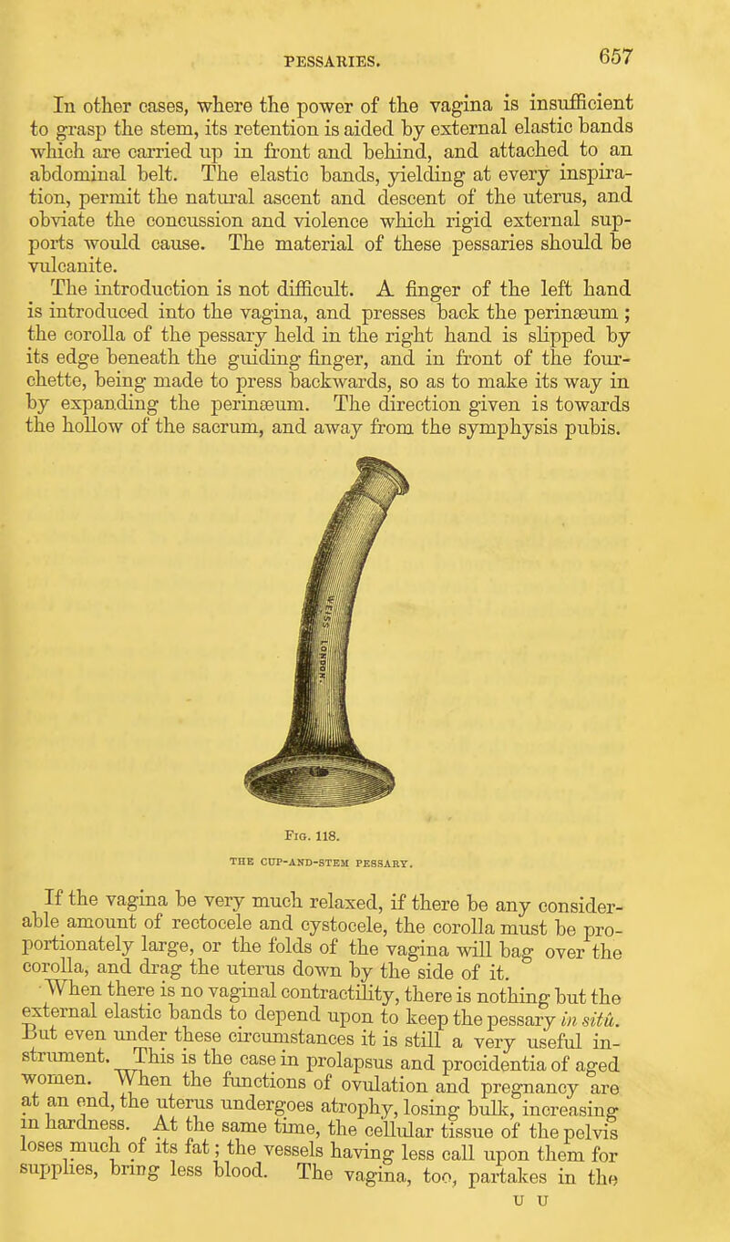 In other cases, where the power of the vagina is insufficient to grasp the stem, its retention is aided hy external elastic bands which are carried up in front and behind, and attached to an abdominal belt. The elastic bands, yielding at every inspira- tion, permit the natural ascent and descent of the uterus, and obviate the concussion and violence which rigid external sup- ports avouM cause. The material of these pessaries should be vulcanite. The introduction is not difficult. A finger of the left hand is introduced into the vagina, and presses back the perinseum ; the corolla of the pessary held in the right hand is slipped by its edge beneath the guiding finger, and in front of the four- chette, being made to press backwards, so as to make its way in by expanding the perinaeum. The direction given is towards the hollow of the sacrum, and away from the symphysis pubis. Fig. 118. the cup-and-stem pessary. If the vagina be very much relaxed, if there be any consider- able^ amount of rectoeele and cystocele, the corolla must be pro- portionately large, or the folds of the vagina will bag over the corolla, and drag the uterus down by the side of it. When there is no vaginal contractility, there is nothing but the external elastic bands to depend upon to keep the pessary in situ. .but even under these circumstances it is still a very useful in- strument. This is the casein prolapsus and procidentia of aged women. When the functions of ovulation and pregnancy are at an end, the uterus undergoes atrophy, losing bulk, increasing in hardness. At the same time, the cellular tissue of the pelvis loses much of its fat; the vessels having less call upon them for supplies, bring less blood. The vagina, too, partakes in the u u