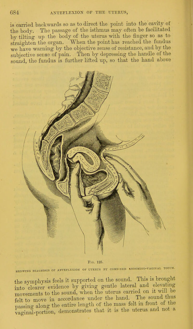 is carried backwards so as to direct the point into the cavity of the body. The passage of the isthmus may often be facilitated by tilting up the body of the uterus with the finger so as to straighten the organ. When the point has reached the fundus we have warning by the objective sense of resistance, and by the subjective sense of pain. Then by depressing the handle of the sound, the fundus is further lifted up, so that the hand above SHOWING DIAGNOSIS Fio. 125. OF ANTEFLEXION OF UTEEUS BY COMBINED ABDOMINOVAGINAL TOUCH. the symphysis feels it supported on the sound. This is brought into clearer evidence by giving gentle lateral and elevating movements to the sound, when the uterus carried on it will be felt to move in accordance under the hand. The sound thus passing along the entire length of the mass felt in front of the vao-inal-portion, demonstrates that it is the uterus and not a