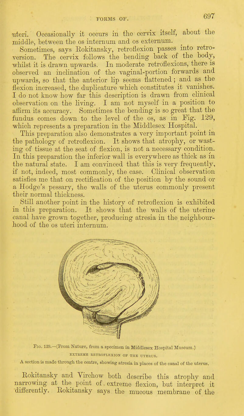 FORMS OF. uteri. Occasionally it occurs in the cervix itself, about the middle, between the os internum and os externum. Sometimes, says Eokitansky, retroflexion passes into retro- version. The cervix follows the bending back of the body, whilst it is drawn upwards. In moderate retroflexions, there is observed an inclination of the vaginal-portion forwards and upwards, so that the anterior Hp seems flattened; and as the flexion increased, the duplicature which constitutes it vanishes. I do not know how far this description is drawn from clinical observation on the living. I am not myself in a position to affirm its accuracy. Sometimes the bending is so great that the fundus comes down to the level of the os, as in Fig. 129, which represents a preparation in the Middlesex Hospital. Tbis preparation also demonstrates a very important point in the pathology of retroflexion. It shows that atrophy, or wast- ing of tissue at the seat of flexion, is not a necessary condition. In this preparation the inferior wall is everywhere as thick as in the natural state. I am convinced that this is very frequently, if not, indeed, most commonly, the case. Clinical observation satisfies me that on rectification of tbe position by the sound or a Hodge's pessary, the walls of the uterus commonly present their normal thickness. Still another point in the history of retroflexion is exhibited in this preparation. It shows that the walls of the uterine canal have grown together, producing atresia in the neighbour- hood of the os uteri internum. Flo. 129.—(From Nature, from a specimen in Middlesex Hospital Museum.) EXTREME RETROFLEXION OF THE UTERUS. A section is made through the centre, showing atresia in places of the canal of the uterus. Rokitansky and Virchow both describe this atrophy and nan-owing at the point of extreme flexion, but interpret it differently. Eokitansky says the mucous membrane of the