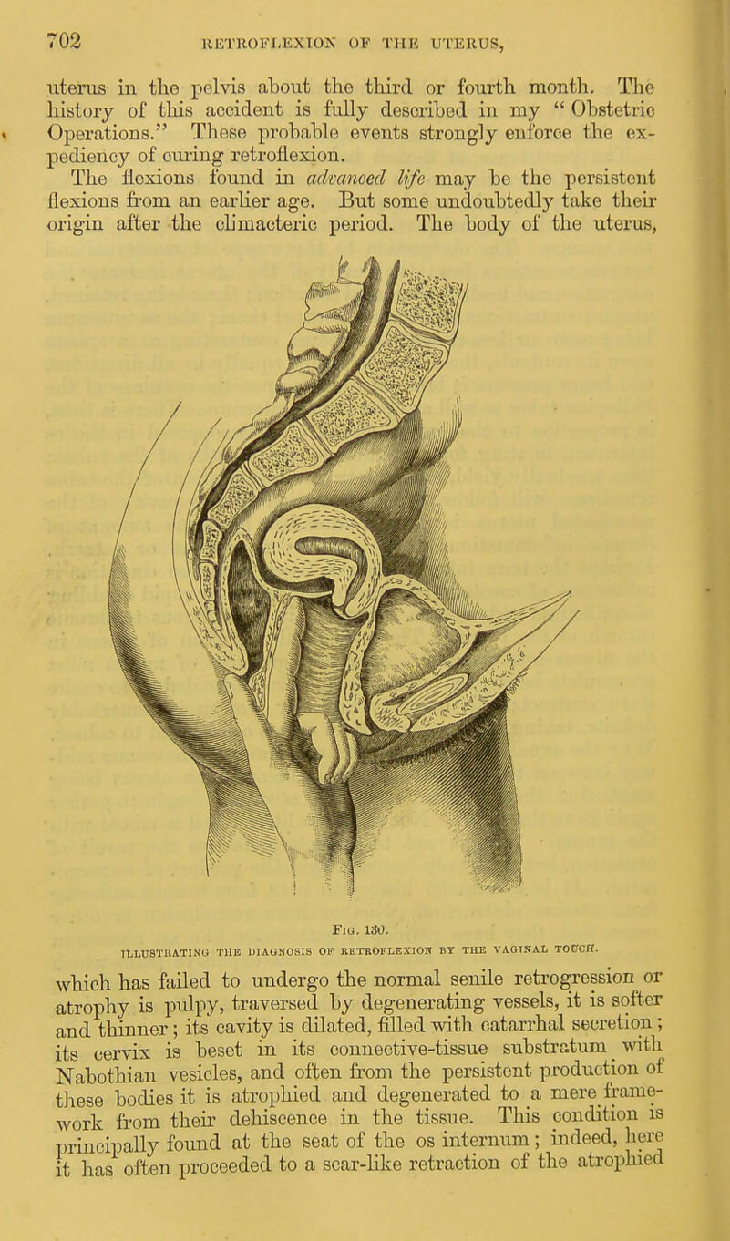 uterus in the pelvis about the third or fourth month. The history of this accident is fully described in my  Obstetric Operations. These probable events strongly enforce the ex- pediency of oming retroflexion. The flexions found in advanced life may be the persistent flexions from an earlier age. But some undoubtedly take their origin after the climacteric period. The body of the uterus, Fio. 130. 1LLUSTUATINU THE DIAGNOSIS OF EETBOFLEXIOH BY THE VAGINAL TOUCH. which has failed to undergo the normal senile retrogression or atrophy is pulpy, traversed by degenerating vessels, it is softer and thinner; its cavity is dilated, filled with catarrhal secretion ; its cervix is beset in its connective-tissue substratum _ with Nabothian vesicles, and often from the persistent production of these bodies it is atrophied and degenerated to a mere frame- work from their dehiscence in the tissue. This condition is principally found at the seat of the os internum; indeed, here it has often proceeded to a scar-like retraction of the atrophied