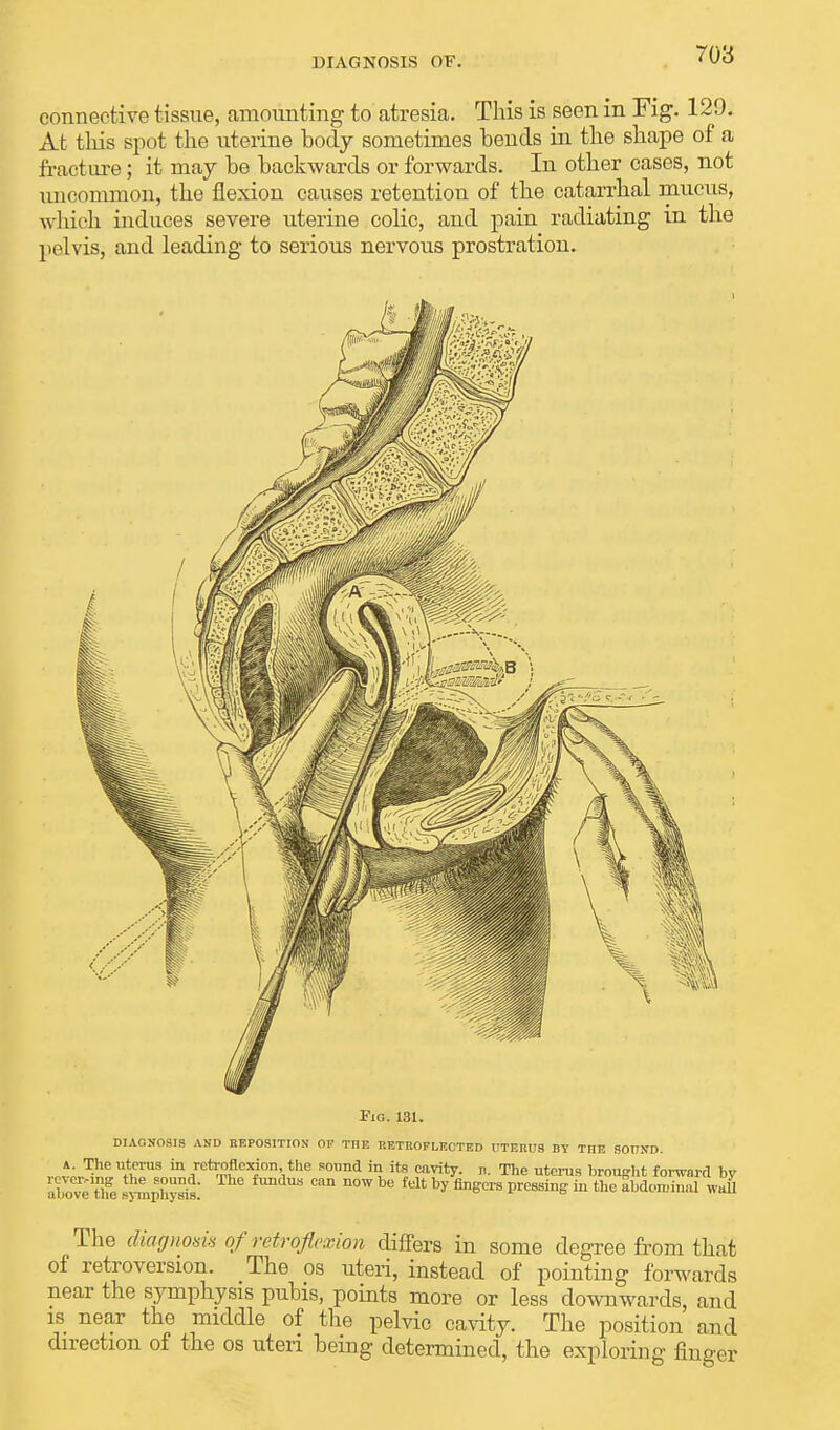 connective tissue, amounting to atresia. This is seen in Fig. 129. At this spot the uterine body sometimes bends in the shape of a fracture; it may be backwards or forwards. In other cases, not uncommon, the flexion causes retention of the catarrhal mucus, which induces severe uterine colic, and pain radiating in the pelvis, and leading to serious nervous prostration. Fig. 131. DIAGNOSIS AND REPOSITION OP TI1F, RETROPLF.CTED UTERUS BY THE SOUND. a. The uterus in retroflexion the sound in its cavity, u. The uterus brought forward by SveZe *4phS2: ^ D0W be fdt ^ ^ors pressing in the abdominal wall The diagnosis of'retroflexion differs in some degree from that of retroversion. The os uteri, instead of pointing forwards near the symphysis pubis, points more or less downwards, and is near the middle of the pelvic cavity. The position and direction of the os uteri being determined, the exploring finger