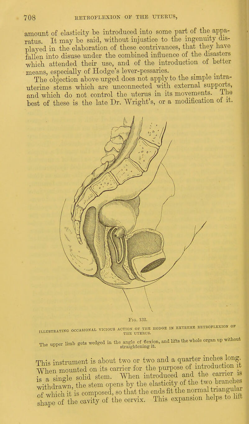 amount of elasticity be introduced into some part of the appa- ratus. It may be said, without injustice to the ingenuity dis- played in the elaboration of these contrivances, that they have fallen into disuse under the combined influence of the disasters which attended their use, and of the introduction of better means, especially of Hodge's lever-pessaries. § The objection above urged does not apply to the simple intra- uterine stems which are unconnected with external supports, and which do not control the uterus in its movements, J. he best of these is the late Dr. Wright's, or a modification ot it. Fig. 132. IU.USTRAT.VG OCCASION VICIOUS ACTION OF THE I.ODOE IN EXTRE3IE RETROFLEXION OF ILLUBiK THE UTERUS. The upper limb gets wedged in the angle of flexion, and lifts the whole organ up without xue w= ° straightening it. This instrument is about two or two and a quarter inches. Ira* When mounted on its carrier for the purpose of introduction t a single solid stem. When introduced and the earner is witMrawn, the stem opens by the elasticity of the two branches of wh ch it is composed, so that the ends fit the normal trianguhu Shape of the cavity of the cervix. This expansion helps to hit