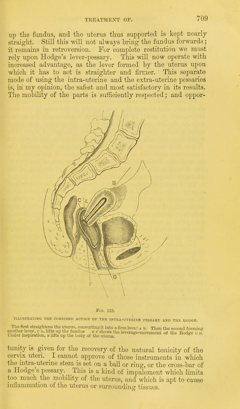 up the fundus, and the uterus thus supported is kept nearly straight. Still this will not always hring the fundus forwards; it remains in retroversion. Fur complete restitution we must rely upon Hodge's lever-pessary. This will now operate with increased advantage, as the lever formed by the uterus upon which it has to act is straighter and firmer. This separate mode of using the intra-uterine and the extra-uterine pessaries is, in my opinion, the safest and most satisfactory in its results. The mobility of the parts is sufficiently respected; and oppor- Fio. 133. ILLUSTRATING THE COMBINED ACTION OF THE INTRA-UTERINE PESSARY AND THE HODGE. The first straightens the uteru«, eonvertingit into afirm lever a n. Then the second forming another lever, c d, lifts up the fundus e f shows the leverage-movement of the Hodge c d. Under inspiration, e lifts up the body of the uterus. tunity is given for the recovery of the natural tonicity of the cervix uteri. _ I cannot approve of those instruments in which the intra-uterine stem is set on a ball or ring, or the cross-bar of a Hodge's pessary. This is a kind of impalement which limits too much the mobility of the uterus, and which is apt to cause inflammation of the uterus or surrounding tissues.