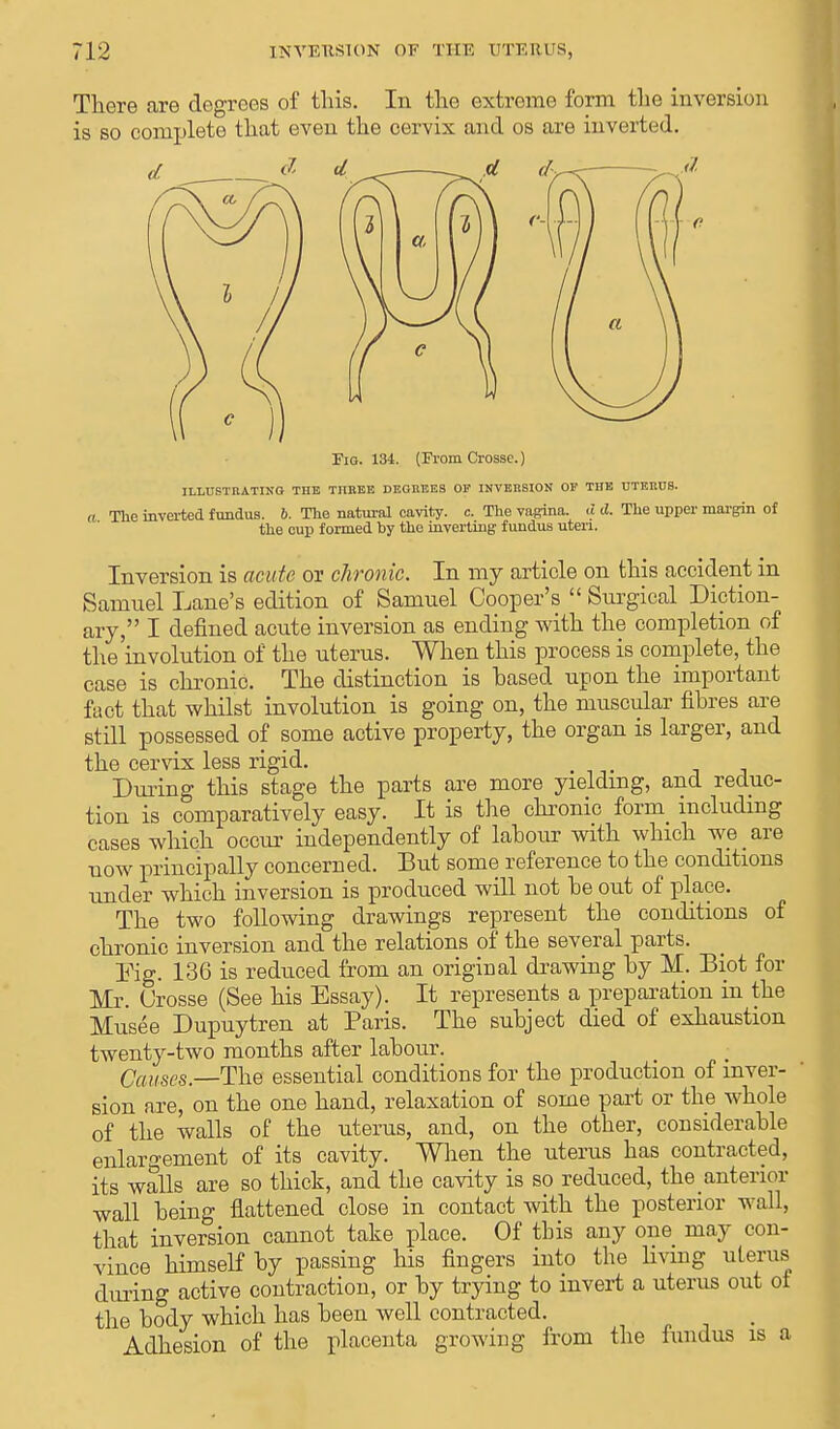 There are degrees of this. In the extreme form the inversion is so complete that even the cervix and os are inverted. Fio. 134. (From Crosse.) ILLUSTRATING THE THREE DEGREES OF INVERSION OP THE UTERUB. ft The inverted fundus, b. The natural cavity, c. The vagina, d d. The upper margin of the cup formed by the inverting fundus uteri. Inversion is acute or chronic. In my article on this accident in Samuel Lane's edition of Samuel Cooper's  Surgical Diction- ary, I defined acute inversion as ending with the completion of the'involution of the uterus. When this process is complete, the case is chronic. The distinction is hased upon the important fact that whilst involution is going on, the muscular fibres are still possessed of some active property, the organ is larger, and the cervix less rigid. During this stage the parts are more yielding, and reduc- tion is comparatively easy. It is the chronic form including cases which occur independently of labour with which we are now principally concerned. But some reference to the conditions under which inversion is produced will not be out of place. The two following drawings represent the conditions of chronic inversion and the relations of the several parts. Fig. 136 is reduced from an original drawing by M. Biot for Mr. Crosse (See his Essay). It represents a preparation in the Musee Dupuytren at Paris. The subject died of exhaustion twenty-two months after labour. Causes— The essential conditions for the production of inver- sion are, on the one hand, relaxation of some part or the whole of the walls of the uterus, and, on the other, considerable enlargement of its cavity. When the uterus has contracted, its walls are so thick, and the cavity is so reduced, the anterior wall being flattened close in contact with the posterior wall, that inversion cannot take place. Of tbis any one may con- vince himself by passing his fingers into the living uterus during active contraction, or by trying to invert a uterus out oi the body which has been well contracted. Adhesion of the placenta growing from the fundus is a