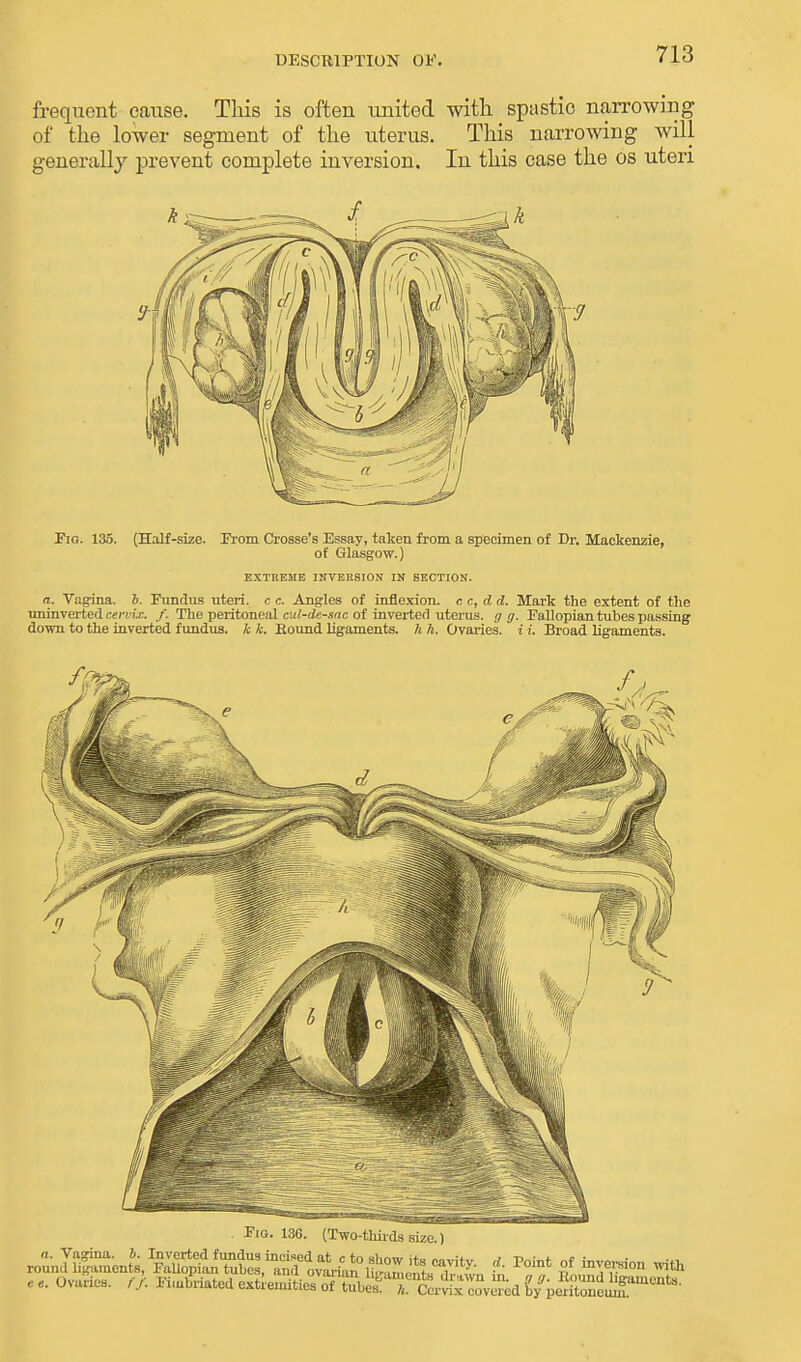 DESCRIPTION OF. frequent cause. This is often united with spastic narrowing of the lower segment of the uterus. This narrowing will generally prevent complete inversion. In this case the os uteri Fio. 135. (Half-size. From Crosse's Essay, taken from a specimen of Dr. Mackenzie, of Glasgow.) EXTREME INVERSION IN SECTION. a. Vagina, b. Fundus uteri, c c. Angles of inflexion, r. c, d d. Mark the extent of the uninverted cervix, f. The peritoneal cul-de-sac of inverted uterus, g g. Eallopian tubes passing down to the inverted fundus, k k. Round ligaments, h h. Ovaries, i i. Broad ligaments.