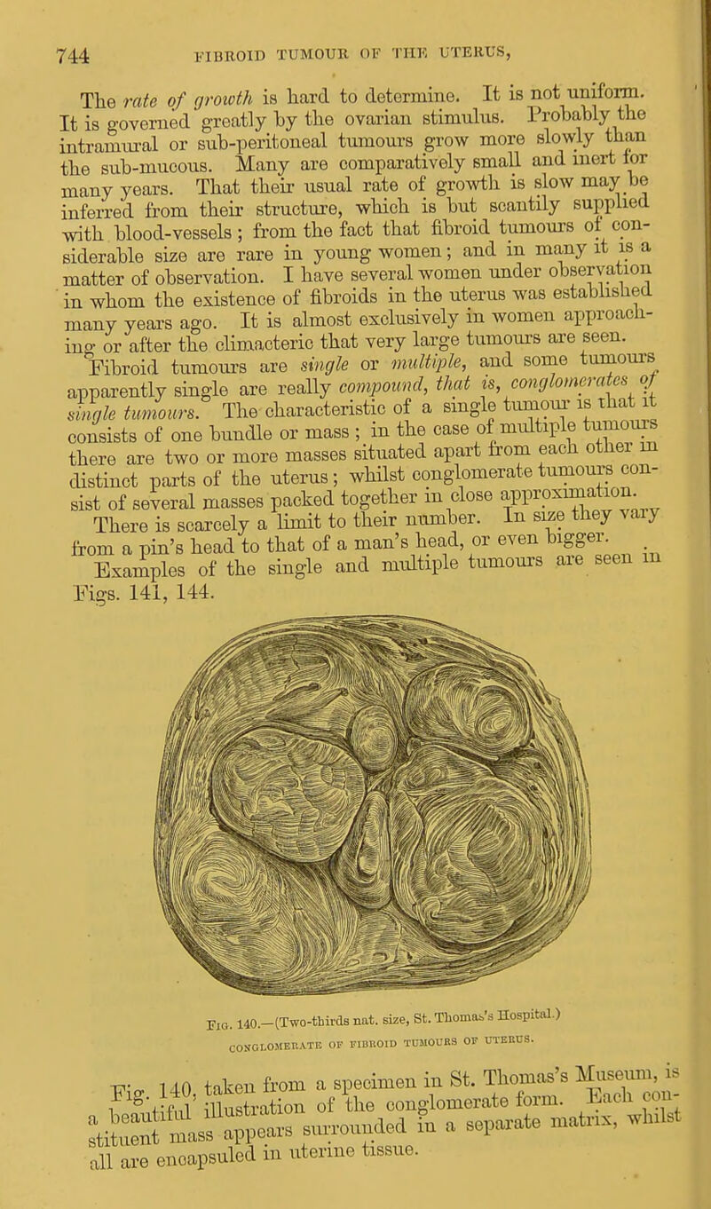 The rate of growth is hard to determine. It is not uniform. It is governed greatly by the ovarian stimulus. Probably the intramural or sub-peritoneal tumours grow more slowly than the sub-mucous. Many are comparatively small and inert ior many years. That their usual rate of growth is slow may be inferred from their structure, which is but scantily supplied with blood-vessels; from the fact that fibroid tumours of con- siderable size are rare in young women; and in many it is a matter of observation. I have several women under observation in whom the existence of fibroids in the uterus was established many years ago. It is almost exclusively in women approach- ing or after the climacteric that very large tumours are seen. Fibroid tumours are single or multiple, and some tumours apparently single are really compound, that is conglomerates of single tumours The characteristic of a single tumour is that it consists of one bundle or mass ; in the case of multiple tumours there are two or more masses situated apart from each other in distinct parts of the uterus; whilst conglomerate tumours con- sist of several masses packed together in close approximation There is scarcely a limit to their number. In size they vary from a pin's head to that of a man's head or even bigger Examples of the single and multiple tumours are seen m Figs. 141, 144. Fig. i40.-(Two-tMrd8 nat. size, St. Thome's Hospital.) CONGLOMERATE OF FIBROID TUMOURS OF UTERUS. T7-„ UO taken from a specimen in St. Thomas's Museum, is 1 ™KM illustration of the conglomerate form. Each oon- StoSt^S— ded * a separate matnx, wmlst all are encapsuled in uterine tissue.