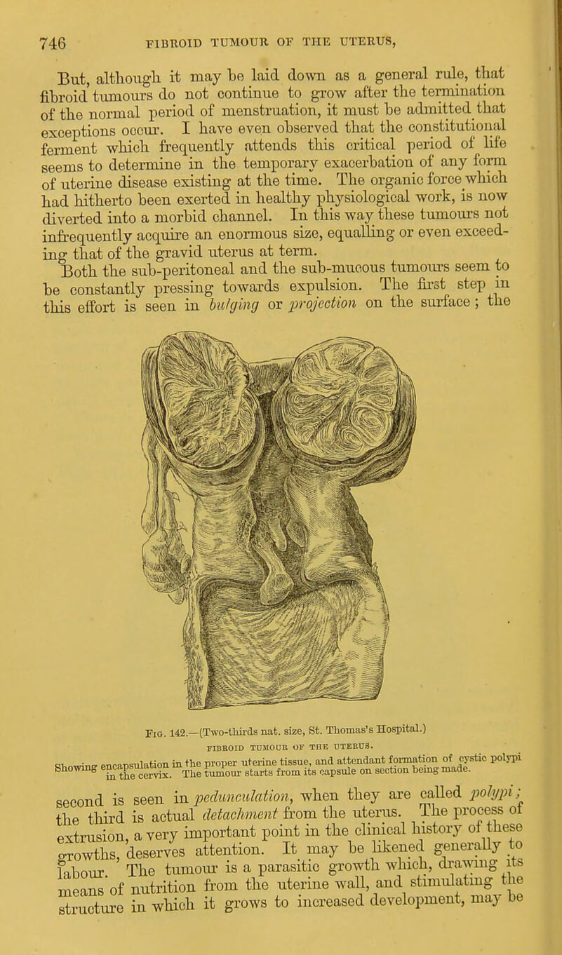 But although it may he laid down as a general rule, that fihroid tumours do not continue to grow after the termination of the normal period of menstruation, it must he admitted that exceptions occur. I have even ohserved that the constitutional ferment which frequently attends this critical period of life seems to determine in the temporary exacerbation of any form of uterine disease existing at the time. The organic force which had hitherto been exerted in healthy physiological work, is now diverted into a morbid channel. In this way these tumours not infrequently acquire an enormous size, equalling or even exceed- ing that of the gravid uterus at term. Both the sub-peritoneal and the sub-mucous tumours seem to be constantly pressing towards expulsion. The first step in this effort is seen in bulging or projection on the surface; the Fig. 142.—(Two-thirds nat. size, St. Thomas's Hospital.) FIBROID TUMOUR OF THE UTERUS. Rfcowin* encapsulation in the proper uterine tissue, and attendant formation of cystic polypi Showing e™']^^_ The £um0ur starts from its capsule on section heing made. second is seen in peclunculation, when they are called polypi; the third is actual detachment from the uterus. The process of extrusion, a very important point in the clinical history of these growths, deserves attention. It may be likened generally to lihour The tumour is a parasitic growth which, drawing its means*of nutrition from the uterine wall, and stimulating the Sure in which it grows to increased development, may be