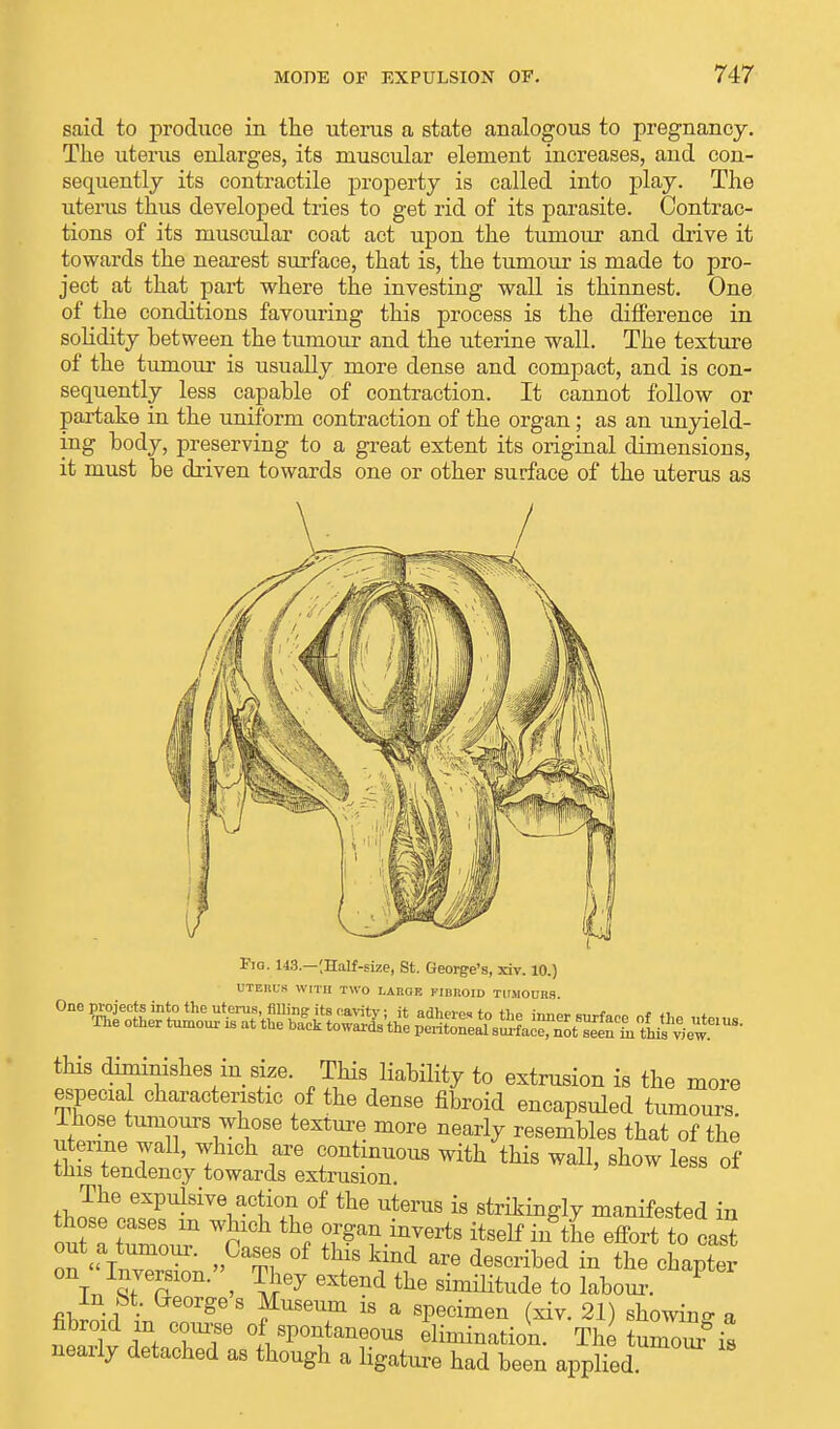 said to produce in the uterus a state analogous to pregnancy. The uterus enlarges, its muscular element increases, and con- sequently its contractile property is called into play. The uterus thus developed tries to get rid of its parasite. Contrac- tions of its muscular coat act upon the tumour and drive it towards the nearest surface, that is, the tumour is made to pro- ject at that part where the investing wall is thinnest. One of the conditions favouring this process is the difference in solidity between the tumour and the uterine wall. The texture of the tumour is usually more dense and compact, and is con- sequently less capable of contraction. It cannot follow or partake in the uniform contraction of the organ; as an unyield- ing body, preserving to a great extent its original dimensions, it must be driven towards one or other surface of the uterus as Fig. 143.—(Half-size, St. George's, xiv. 10.) UTERUS WITH TWO LARGE FIBIIOID TUMOURS ^^^^ this diminishes in size. This liability to extrusion is the more especial characteristic of the dense fibroid encapsuled tumours lhose tumours whose texture more nearly resembles that of the u mne wall, which are continuous with this wall, show less of this tendency towards extrusion. twt^^Vf °£ °f the Uterus is ^ikingly manifested in ouH hZ m WpCh th,6 ?^a™rts itself ™^ eff°ri to cast out a tumour. Cases of this kind are described in the chapter on Inversion. They extend the similitude to labour. P In ht. Georges Museum is a specimen (xiv. 21) showing a SffTTf,^ elimination. The turnout is nearly detached as though a ligature had been applied.