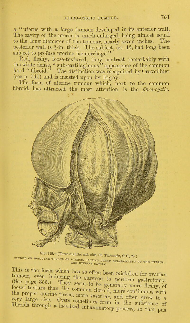 FIBR0-CYST1C TUMOUR. a  uterus with a large tumour developed in its anterior wall. The cavity of the uterus is much enlarged, being almost equal to the long diameter of the tumour, nearly seven inches. The posterior wall is f-in. thick. The subject, £et. 45, had long been subject to profuse uterine hemorrhage. Bed, fleshy, loose-textured, they contrast remarkably with the white dense,  sub-cartilaginous  appearance of the common hard  fibroid. The distinction was recognised by Cruveilhier (see p. 741) and is insisted upon by Eigby. The form of uterine tumour which, next to the common fibroid, has attracted the most attention is the fibro-cystic. Pio. 145.-(Tbree-eighths nat. rise, St. Thomas's, G G, 29 ) FIBROID OR MUSCULAR TUMOUR OF UTERUS. CAUSIVr ™„ AND UTERINE <>* THE UTERUS