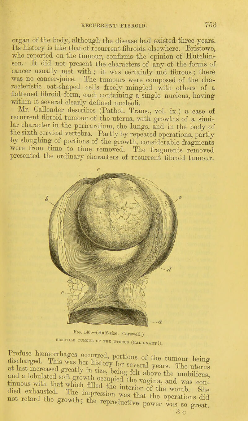 RECURRENT FIBROID. 758 organ of the body, although the disease had existed three years. Its history is like that of recurrent fibroids elsewhere. Bristowe, who reported on the tumour, confirms the opinion of Hutchin- son. It did not present the characters of any of the forms of cancer usually met with; it was certainly not fibrous; there was no cancer-juice. The tumours were composed of the cha- racteristic oat-shaped cells freely mingled with others of a flattened fibroid form, each containing a single nucleus, having within it several clearly defined nucleoli. Mr. Callender describes (Pathol. Trans., vol. ix.) a case of recurrent fibroid tumour of the uterus, with growths of a simi- lar character in the pericardium, the lungs, and in the body of the sixth cervical vertebra. Partly by repeated operations, partly by sloughing of portions of the growth, considerable fragments were from time to time removed. The fragments removed presented the ordinary characters of recurrent fibroid tumour. Fig. 146.-(Half-size. CarsweU.) ERECTILE TUMOUR OF THE UTERUS (MALIGNANT ?). at last increased greatly in^ The and a lobulated soft growth occuSgt£ ™ th°umM™™> tinuous with that which filled Tlf 6 aM TS COn died exhausted. The impression vl fW0^ She not retard the growth XTproiive 1  °Peratl°nS did ' ^roauctive power was so great 3 c