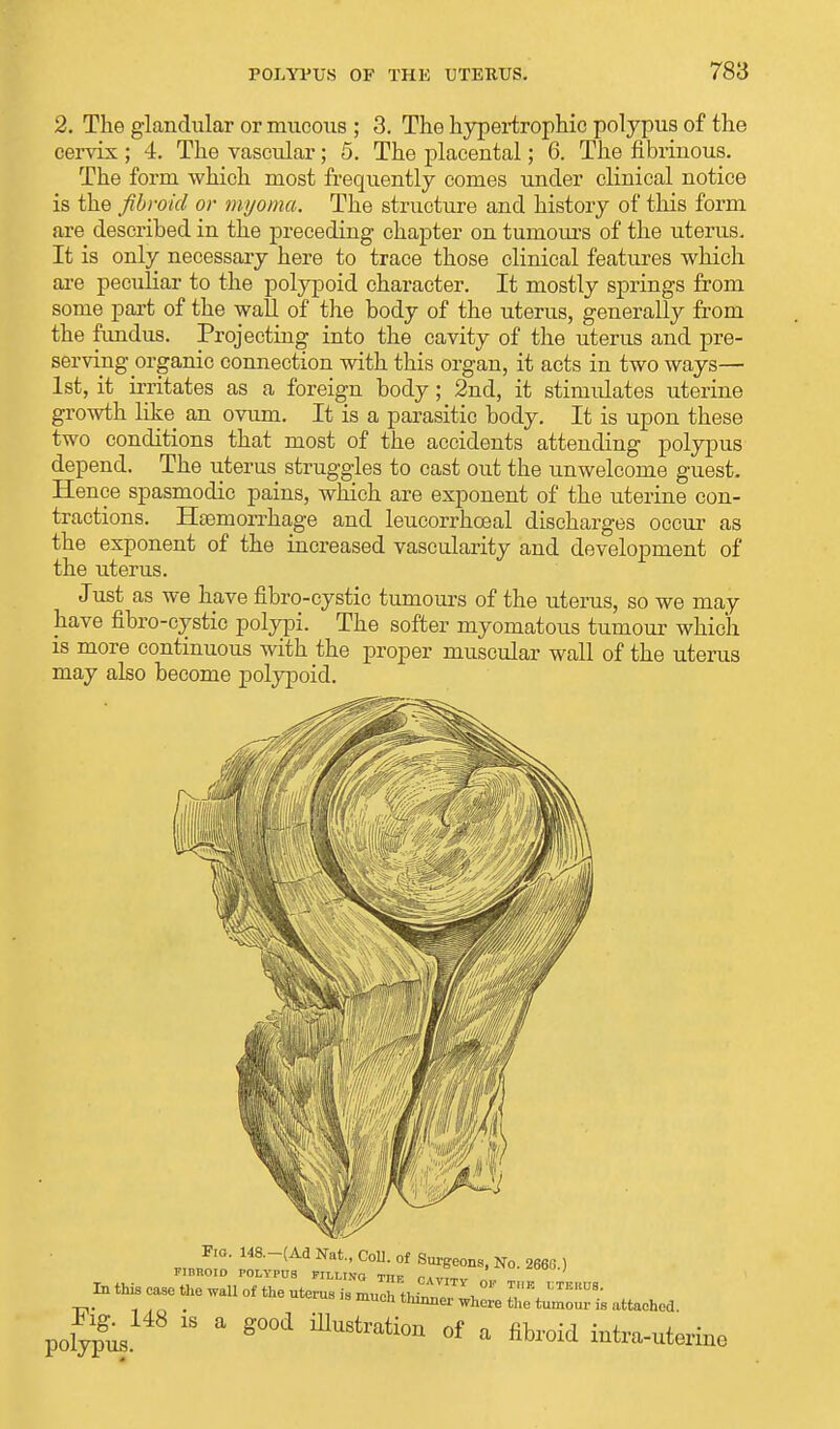 2. The glandular or mucous ; 3. The hypertrophic polypus of the cervix ; 4. The vascular; 5. The placental; 6. The fibrinous. The form which most frequently comes under clinical notice is the fibroid or myoma. The structure and history of this form are described in the preceding chapter on tumours of the uterus. It is only necessary here to trace those clinical features which are peculiar to the polypoid character. It mostly springs from some part of the wall of the body of the uterus, generally from the fundus. Projecting into the cavity of the uterus and pre- serving organic connection with this organ, it acts in two ways— 1st, it irritates as a foreign body; 2nd, it stimidates uterine growth like an ovum. It is a parasitic body. It is upon these two conditions that most of the accidents attending polypus depend. The uterus struggles to cast out the unwelcome guest. Hence spasmodic pains, which are exponent of the uterine con- tractions. Haemorrhage and leucorrhceal discharges occur as the exponent of the increased vascularity and development of the uterus. Just as we have fibro-cystic tumours of the uterus, so we may have fibro-cystic polypi. The softer myomatous tumour which is more continuous with the proper muscular wall of the uterus may also become polypoid. r,„™ °' 148'_(Ad Nat' C°U- °f Sur^e0ns. No. 2666.) FIBHOID POLYPUS FILLING TIIF r a In this case a, „„ „, «. «.,. ^™, pol^L 18 a 8°0i mUStrati°n of a abroid iatra-uferine