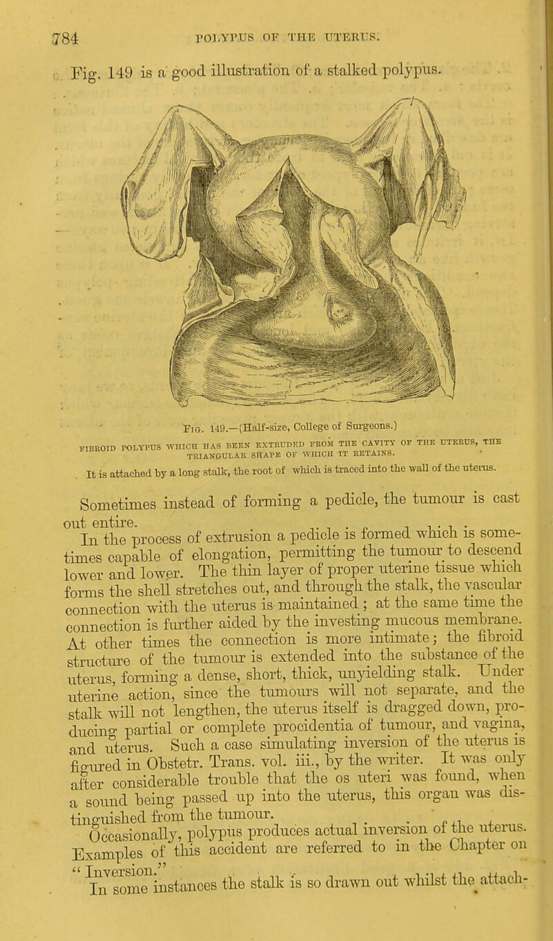 Fig. 149 is a' good illustration of a stalked polypus. Fio. 149.—(Half-size, College of Surgeons.) FIBROID POLYPUS WHICH HAS BEEN EXTRUDED FROM THE CAVITY OF THE UTERUS, THE TRIANGULAR SHAPE OF WHICH IT RETAINS. It is attached by a long stalk, the root of which is traced into the wall of the uterus. Sometimes instead of forming a pedicle, the tumour is cast out entire. . n , . . . In the process of extrusion a pedicle is formed which is some- times capable of elongation, permitting the tumour to descend lower and lower. The thin layer of proper uterine tissue which forms the shell stretches out, and through the stalk, the vascular connection with the uterus is maintained ; at the same tune the connection is further aided by the investing mucous membrane At other times the connection is more intimate; the fibroid structure of the tumour is extended into the substance of the uterus, forming a dense, short, thick, unyielding stalk. Under uterine action, since the tumours will not separate, and the stalk will not lengthen, the uterus itself is dragged down, pro- ducing partial or complete procidentia of tumour, and vagina, and uterus. Such a case simulating inversion of the uterus is figured in Obstetr. Trans, vol. iii., by the writer. It was only alter considerable trouble that the os uteri was found, when a sound being passed up into the uterus, this organ was dis- tinguished from the tumour. > : * Occasionally, polypus produces actual inversion oi tne uterus. Examples of this accident are referred to in the Chapter on  ?n somTinstances the stalk is so drawn out whilst the^ attach-