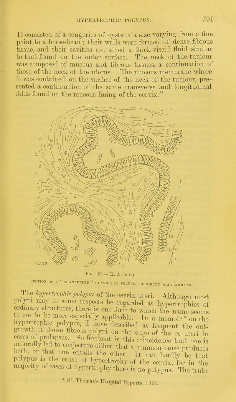 It consisted of a congeries of cysts of a size varying- from a fine point to a horse-bean; their walls were formed of dense fibrous tissue, and their cavities contained a thick viscid fluid similar to that fonnd on the outer surface. The neck of the tumour was composed of mucous and fibrous tissues, a continuation of those of the neck of the uterus. The mucous membrane where it was contained on the surface of the neck of the tumour, pre- sented a continuation of the same transverse and longitudinal folds found on the mucous lining of the cervix. Fig. 152.—(H. Ainott,) SECTION OF A  CHANNELLED  GLANDULAR POLYPUS, SLIGHTLY DIAGRAMMATIC The hypertrophic pokjpua of the cervix uteri. Although most polypi may m some respects be regarded as hypertrophies of ordinary structures, there is one form to which the name seems to me to be more especially applicable. In a memoir * on the hypertrophic polypus, I have described as frequent the out- V &hTS,P°lypi 0U the e%e of the os uteri in ZlWr • ^ freqUlnt is tllis ™idence that one is nolis k tL°ne entfltlle other. It can hardly be that polypus is the cause of hypertrophy of the cervix, for in the majority of cases of hypertrophy there is no polypus! The truth * St. Thomas's Hospital Reports, 1872.