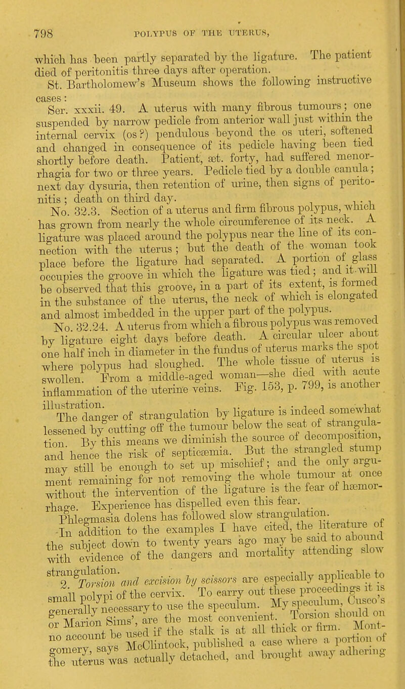 winch has been partly separated by the ligature. The patient died of peritonitis three days after operation. St. Bartholomew's Museum shows the following instructive cases SCO . Ser. xxxii. 49. A uterus with many fibrous tumours ; one suspended by narrow pedicle from anterior wall just within the internal cervix (os ?) pendulous beyond the os uteri, softened and changed in consequence of its pedicle having been tied shortly before death. Patient, set. forty, had suffered menor- rhagia for two or three years. Pedicle tied by a double canula; next day dysuria, then retention of urine, then signs of perito- nitis ; death on third day. No. 32.3. Section of a uterus and firm fibrous polypus, which, has grown from nearly the whole circumference of its neck. A ligature was placed around the polypus near the line of its con- nection with the uterus ; but the death of the woman took place before the ligature had separated. A portion of glass occupies the groove in which the ligature was tied; and it.will be observed that this groove, in a part of its extent, is formed in the substance of the uterus, the neck of which is elongated and almost imbedded in the upper part of the polypus. No 32 24. A uterus from which a fibrous polypus was removed by ligature eight days before death. A circular ulcer about one half inch in diameter in the fundus of uterus marks the spot where polypus had sloughed. The whole tissue of uterus is Twollem From a middfe-aged woman-she died with a^uto inflammation of the uterine veins. Pig. 153, p. 799, is anothei 111 TWanger of strangulation by ligature is indeed somewhat lessened by cutting off the tumour below the seat of strangula- ion By this melns we diminish the source of decomposition, Ind hence the risk of septicemia, But the strangled stump mav still be enough to set up mischief; and the only argu- ment remaining for not removing the whole tumour at once ^tlH&™tum of the ligature is the fear of haemor- rhage Experience has dispelled even this fear Phlegmasia dolens has followed slow strangulation -In addition to the examples I have cited the literature of the siib ect down to twenty years ago may be said to abound iS^f the dangers and mortality attending slow ^T^TonZ'md excision hy scissors are especially applicable to ii n\Z of the cervix To carry out these proceedings il is Z^tlt M»ok, published a case whe, porta oi tTe ute~ actually detUed, a*d brougbt away adhenng
